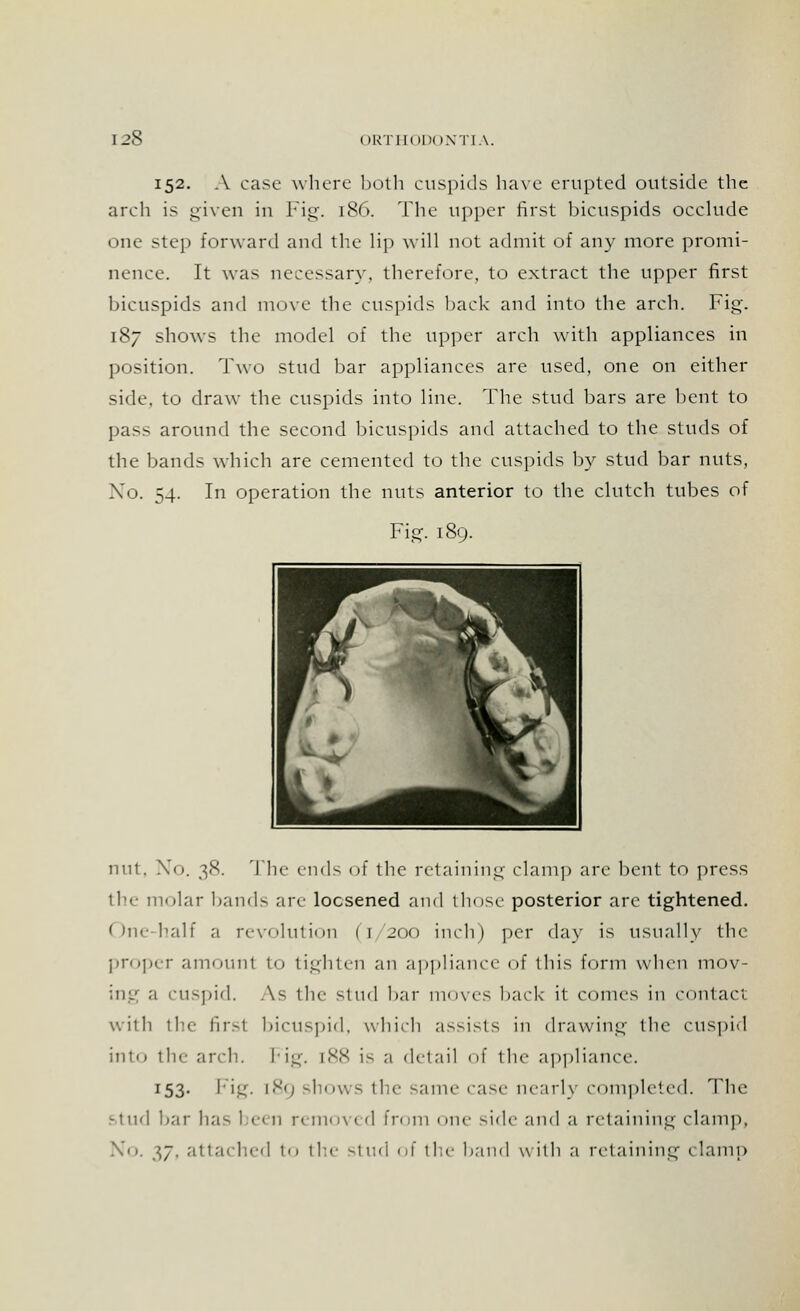 152. A case where both cuspids have erupted outside the arch is given in Fig. 186. The upper first bicuspids occlude one step forward and the lip will not admit of any more promi- nence. It was necessary, therefore, to extract the upper first bicuspids and move the cuspids back and into the arch. Fig. 187 shows the model of the upper arch with appliances in position. Two stud bar appliances are used, one on either side, to draw the cuspids into line. The stud bars are bent to pass around the second bicuspids and attached to the studs of the bands which are cemented to the cuspids by stud bar nuts, No. 54. In operation the nuts anterior to the clutch tubes of Fig. 189. nut, No. 38. The- ends of the retaining clamp are bent to press the molar bands are loosened and those posterior are tightened. One-half a revolution (1/200 inch) per day is usually the proper amount to tighten an appliance of this form when mov- ing a cuspid. As the stud bar muxes back it comes in contad with the lir-i bicuspid, which assists in drawing the cuspid into the arch. Fig. [88 is a detail of the appliance. I53- Fig. 189 shows the same rase nearly completed. The stud bar has been removed From one side and a retaining clamp. No. 37. attached to the stud of the baud with a retaining clamp