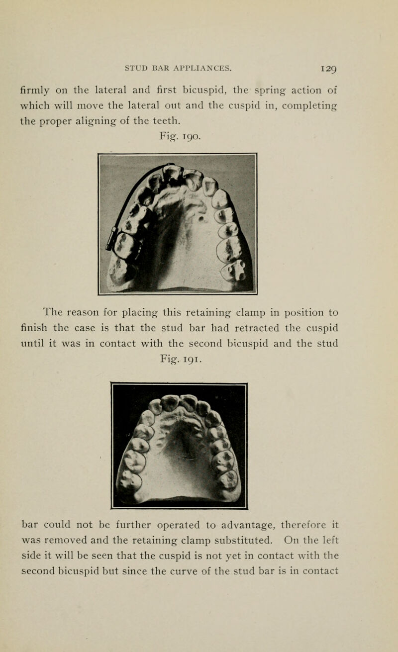 firmly on the lateral and first bicuspid, the spring action of which will move the lateral out and the cuspid in, completing the proper aligning of the teeth. Fig. 190. The reason for placing this retaining clamp in position to finish the case is that the stud bar had retracted the cuspid until it was in contact with the second bicuspid and the stud Fig. 191. bar could not be further operated to advantage, therefore it was removed and the retaining clamp substituted. On the left side it will be seen that the cuspid is not yet in contact with the second bicuspid but since the curve of the stud bar is in contact