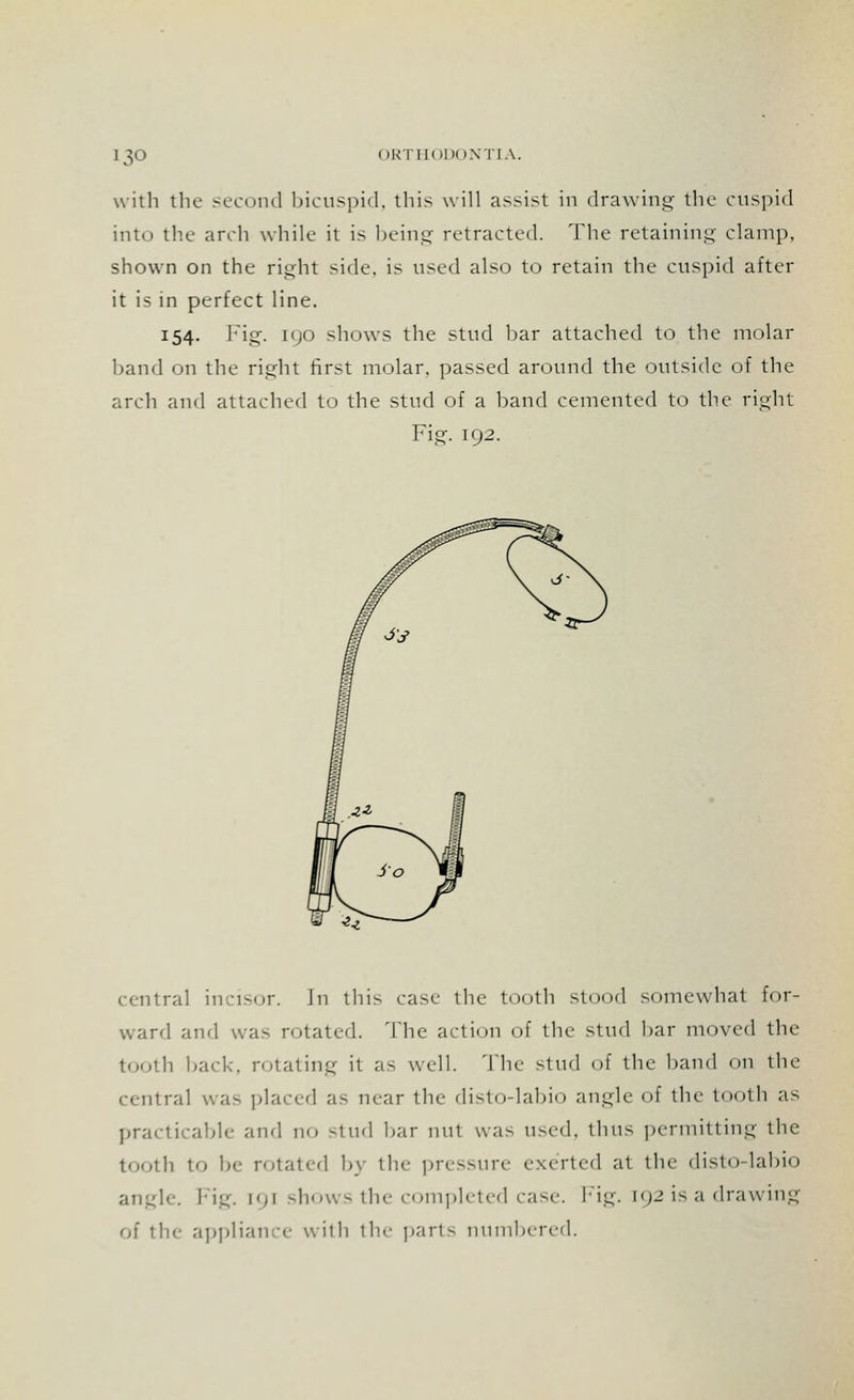 13° with the second bicuspid, this will assist in drawing the cuspid into the arch while it is being retracted. The retaining clamp, shown on the right side, is used also to retain the cuspid after it is in perfect line. 154. Fig. [90 shows the stud har attached to the molar hand on the right first molar, passed around the outside of the arch and attached to the stud of a hand cemented to the right Fig. 192. central incisor. J11 this case the tooth stood somewhat for- ward and was rotated. The action of the stud har moved the tooth back, rotating it as well. The stud of the hand on the central was placed as near the disto-labio angle of the tooth as practicable and no stud har nut was u^vd, thus permitting the tooth to be rotated by the pressure exerted at the disto-labio angle. Fig. [91 shows the completed case. Fig. [92 is a drawing of the appliance with the parts numbered.