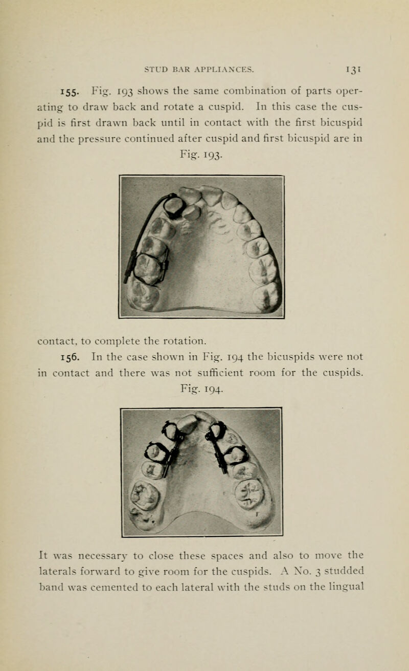x55- Fig- *93 shows the same combination of parts oper- ating to draw back and rotate a cuspid. In this case the cus- pid is first drawn back until in contact with the first bicuspid and the pressure continued after cuspid and first bicuspid are in Fig. 193. contact, to complete the rotation. 156. In the case shown in Fig. 194 the bicuspids were not in contact and there was not sufficient room for the cuspids. Fig. 194. It was necessary to close these spaces and also to move the laterals forward to give room for the cuspids. A Xo. 3 studded band was cemented to each lateral with the studs on the lingual