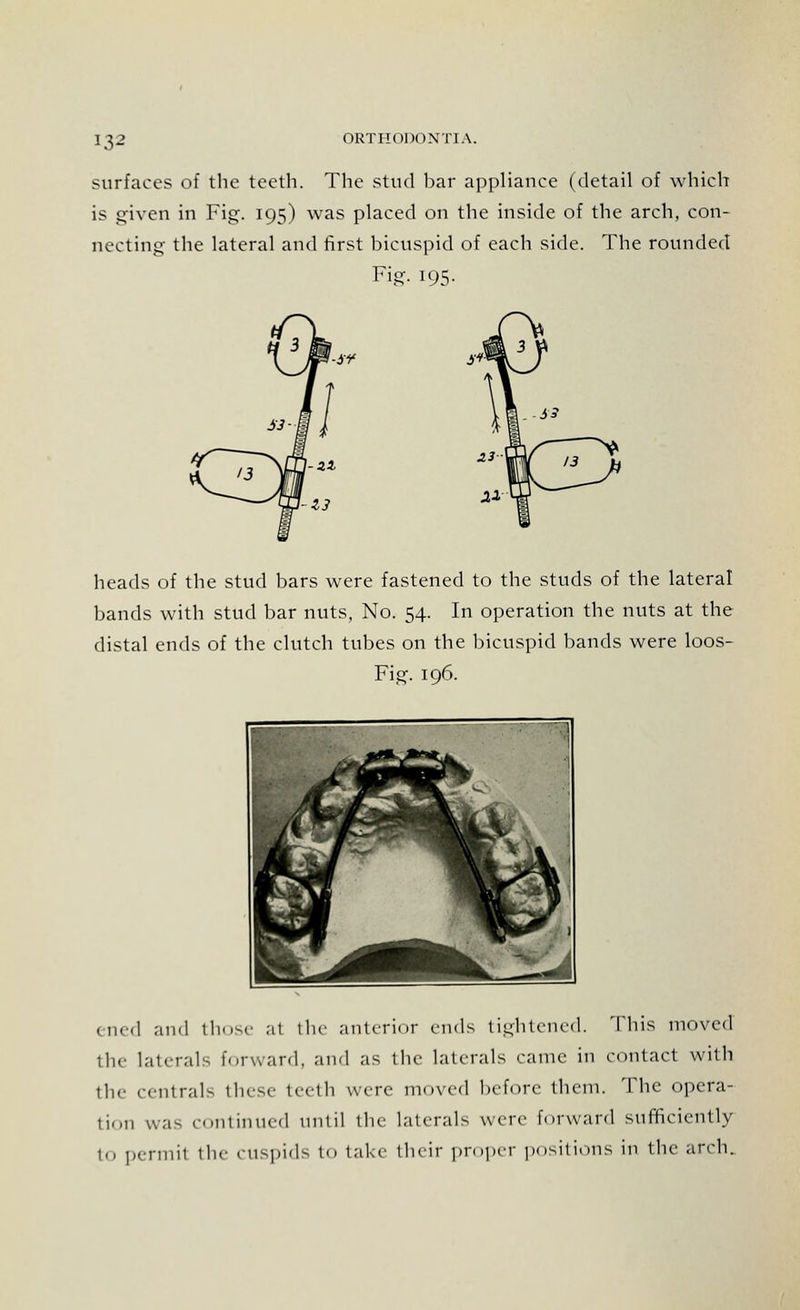 !.32 surfaces of the teeth. The stud bar appliance (detail of which is given in Fig. 195) was placed on the inside of the arch, con- necting the lateral and first bicuspid of each side. The rounded Fig. 195- -$¥ heads of the stud bars were fastened to the studs of the lateral bands with stud bar nuts, No. 54. In operation the nuts at the distal ends of the clutch tubes on the bicuspid bands were loos- Fig. 196. ened and those a1 the anterior ends tightened. This moved the laterals forward, and as the laterals came in contact with the centrals these teeth were moved before them. The opera- tion was continued until tin- laterals were forward sufficiently in permit the rnspids to take their proper positions in the arch.