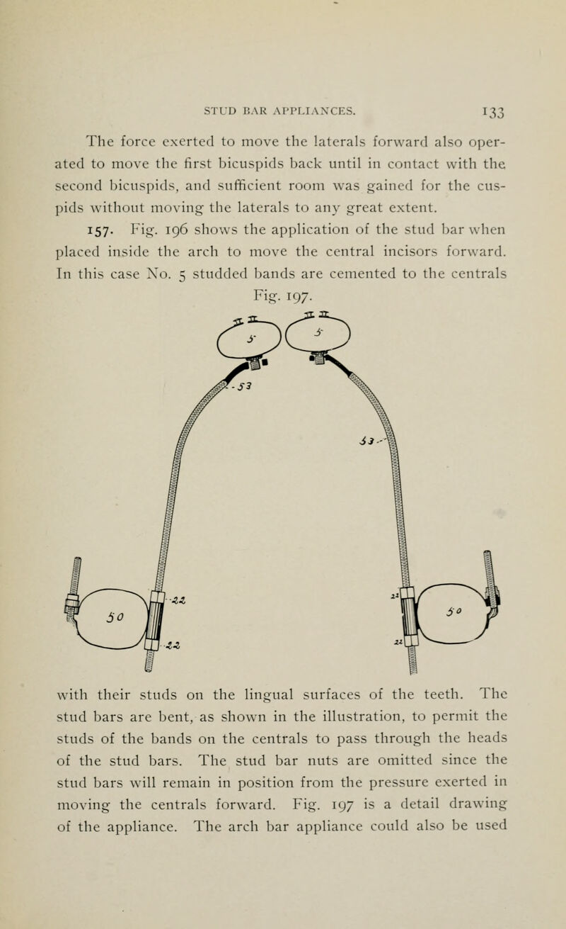 The force exerted to move the laterals forward also oper- ated to move the first bicuspids back until in contact with the second bicuspids, and sufficient room was gained for the cus- pids without moving the laterals to any great extent. J57- Fig- 196 shows the application of the stud bar when placed inside the arch to move the central incisors forward. In this case Xo. 5 studded bands are cemented to the centrals Fig. 197. with their studs on the lingual surfaces of the teeth. The stud bars are bent, as shown in the illustration, to permit the studs of the bands on the centrals to pass through the heads of the stud bars. The stud bar nuts are omitted since the stud bars will remain in position from the pressure exerted in moving the centrals forward. Fig. 197 is a detail drawing of the appliance. The arch bar appliance could also be used
