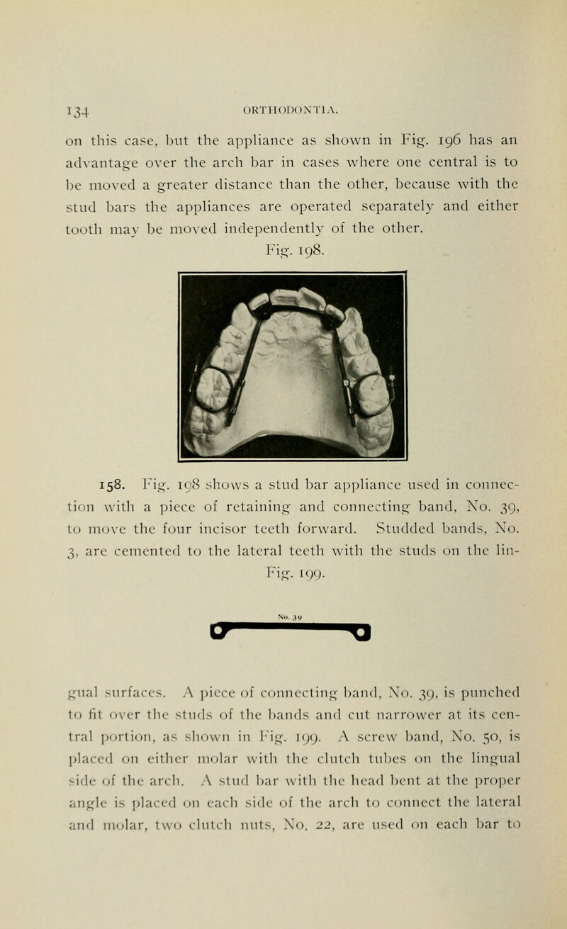 on this case, but the appliance as shown in Fig. 196 has an advantage over the arch bar in cases where one central is to be moved a greater distance than the other, because with the stud bars the appliances are operated separately and either tooth may be moved independently of the other. Fig. 198. 158. Fig. 108 shows a stud bar appliance used in connec- tion with a piece of retaining and connecting band, No. 39, to move the four incisor teeth forward. Studded bands, No. 3, arc cemented to the lateral teeth with the studs on the lin- Fig. [09. (71 gual surfaces. A piece of connecting hand. No. 39, is punched to tit over the studs of the hands and cut narrower at its cen- tral portion, as shown in Fig. l<j<;. A screw hand, Xo. 50, is placed it either molar with the clutch tubes on tin1 lingual side of the arch. A stud bar with the head bent at the proper angle is placed 011 each side of the arch to connect the lateral and molar, two clutch mils, No. 22, are used on each bar to