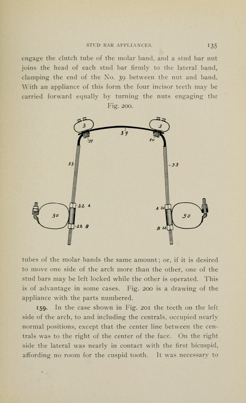 engage the clutch tube of the molar band, and a stud bar nut joins the head of each stud bar firmly to the lateral hand. clamping the end of the Xo. 39 between the nut and hand. With an appliance of this form the four incisor teeth may he- carried forward equally by turning the nuts engaging the Fig. 200. tubes of the molar bands the same amount; or. if it is desired to move one side of the arch more than the other, one of the stud bars may be left locked while the other is operated. This is of advantage in some cases. Fig. 200 is a drawing of the appliance with the parts numbered. 159. In the case shown in Fig. 201 the teeth on the left side of the arch, to and including the centrals, occupied nearly normal positions, except that the center line between the cen- trals was to the right of the center of the face. On the right side the lateral was nearly in contact with the first bicuspid, affording no room for the cuspid tooth. It was necessary to