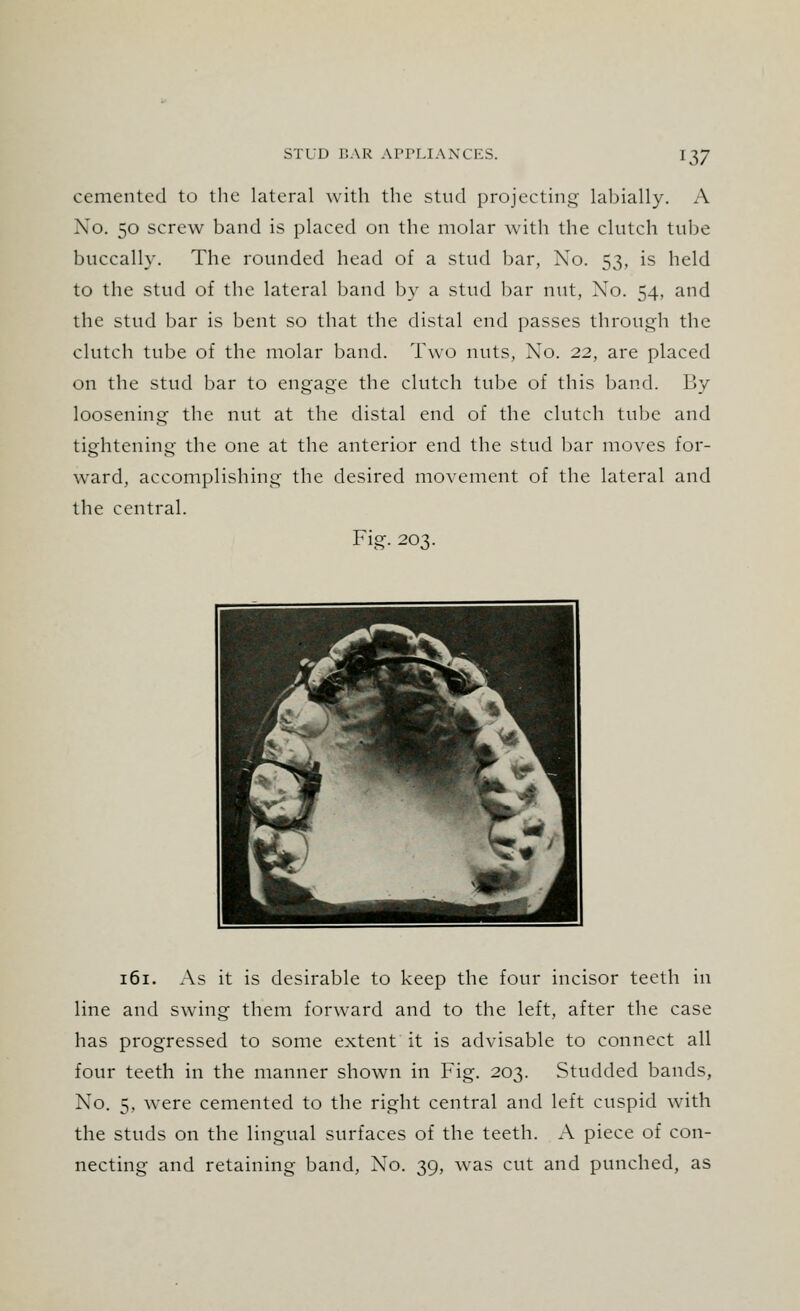 cemented to the lateral with the stud projecting labially. A No. 50 screw band is placed on the molar with the clutch tube buccally. The rounded head of a stud bar, No. 53, is held to the stud of the lateral band by a stud bar nut, No. 54, and the stud bar is bent so that the distal end passes through the clutch tube of the molar band. Two nuts, No. 22, are placed on the stud bar to engage the clutch tube of this band. By loosening the nut at the distal end of the clutch tube and tightening the one at the anterior end the stud bar moves for- ward, accomplishing the desired movement of the lateral and the central. Fig. 203. BH^^ife^ BT^aPoK ^~^*WB H HST * ^» but ^ 1 r mi a - ^^B ■' jf •^ a ^H Bv j r -# 1 ^*'| •* A 161. As it is desirable to keep the four incisor teeth in line and swing them forward and to the left, after the case has progressed to some extent it is advisable to connect all four teeth in the manner shown in Fig. 203. Studded bands, No. 5, were cemented to the right central and left cuspid with the studs on the lingual surfaces of the teeth. A piece of con- necting and retaining band, No. 39, was cut and punched, as