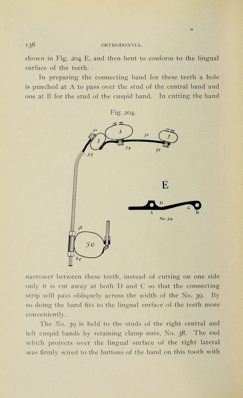 shown in Fig. 204 E. and then bent to conform to the lingual surface of the teeth. In preparing the connecting band for these teeth a hole is punched at A to pass over the stud of the central hand and one at B for the stud of the cuspid hand. In cutting the hand Fig. 204. narrower between these teeth, instead of cutting on one side only it is cut away at both I) and (' so that the connecting strip will pass obliquely across the width of the No. 30. By so doing the hand fits to tin- lingual surface of the teeth more conveniently. The No. 39 is held lo the studs of the right central and lefl cuspid hands h\ retaining clam]) nuts, No. 38. The end which projects over the lingual surface of the right lateral was firmlv wired t<> the buttons of the hand on this tooth with