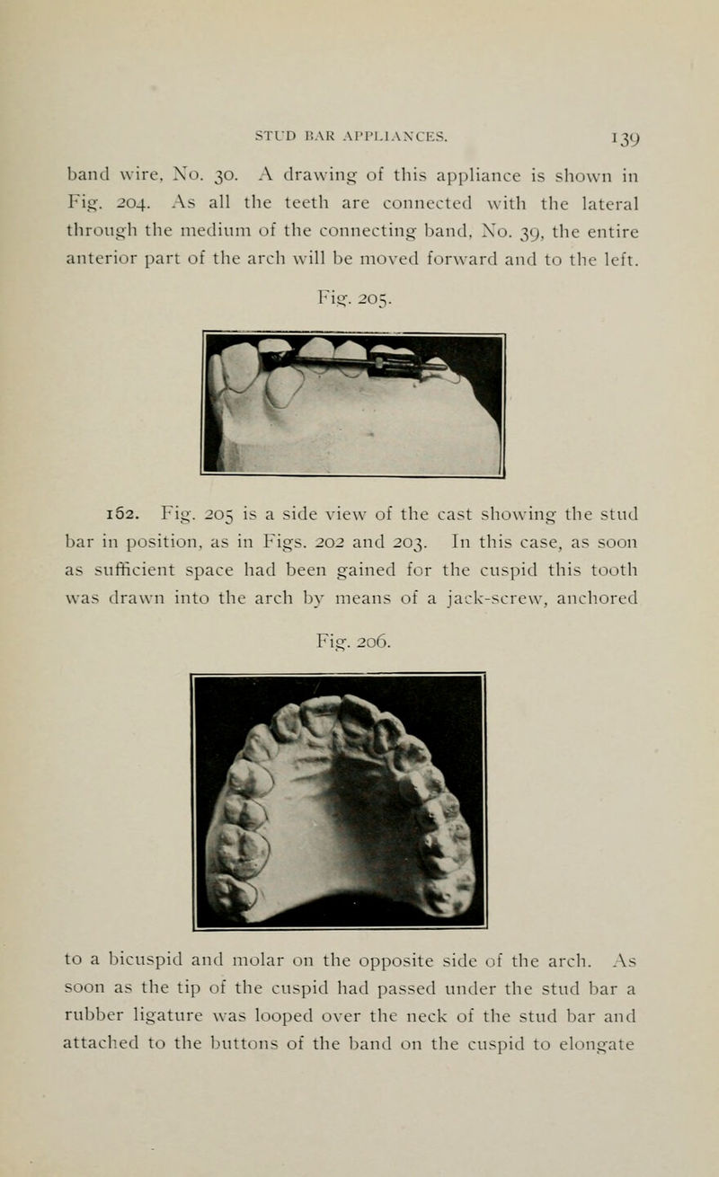 band wire. No. 30. A drawing of this appliance is shown in Fig. 204. As all the teeth are connected with the lateral through the medium of the connecting band. Xo. 39, the entire anterior part of the arch will be moved forward and to the left. Fig. 20 v i52. Fig. 205 is a side view of the cast showing the stud bar in position, as in Figs. 202 and 203. In this case, as soon as sufficient space had been gained for the cuspid this tooth was drawn into the arch by means of a jack-screw, anchored Fie. 206. ■j^^^LjV*^? r ^r v *~m ^^^fc^ \ M jk^V w& v'lk ^ to a bicuspid ami molar on the opposite side of the arch. As soon as the tip of the cuspid had passed under the stud bar a rubber ligature was looped over the neck of the stud bar and attached to the buttons of the band on the cuspid to elongate