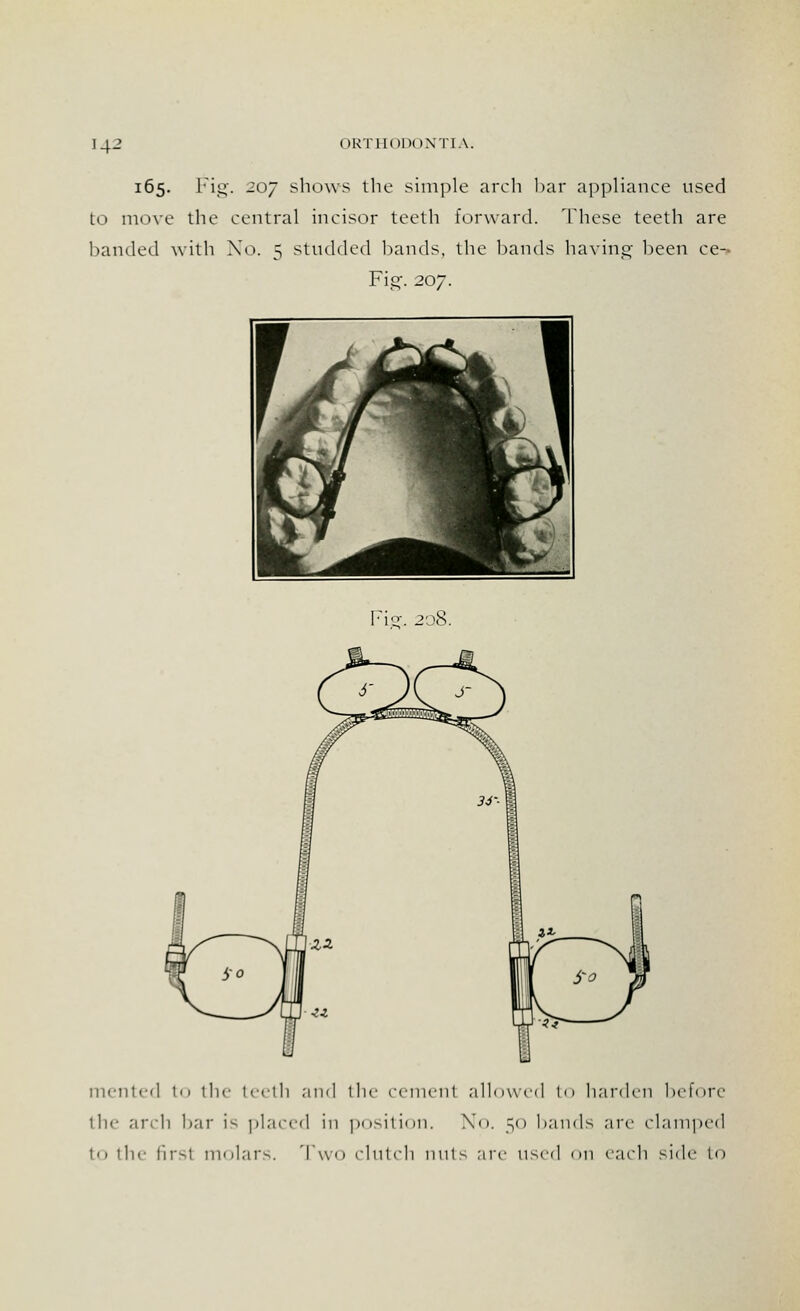 U-' 165. Fig. 207 shows the simple arch bar appliance used to move the central incisor teeth forward. These teeth are banded with No. 5 studded bands, the hands having been ce- Fig. 207. Fig-. 208. mented to the teeth and the cemenl allowed to harden before the arch bar is placed in position. No. 50 bands arc (damped to the firsl molars. Two clutch nuts arc used on each side to