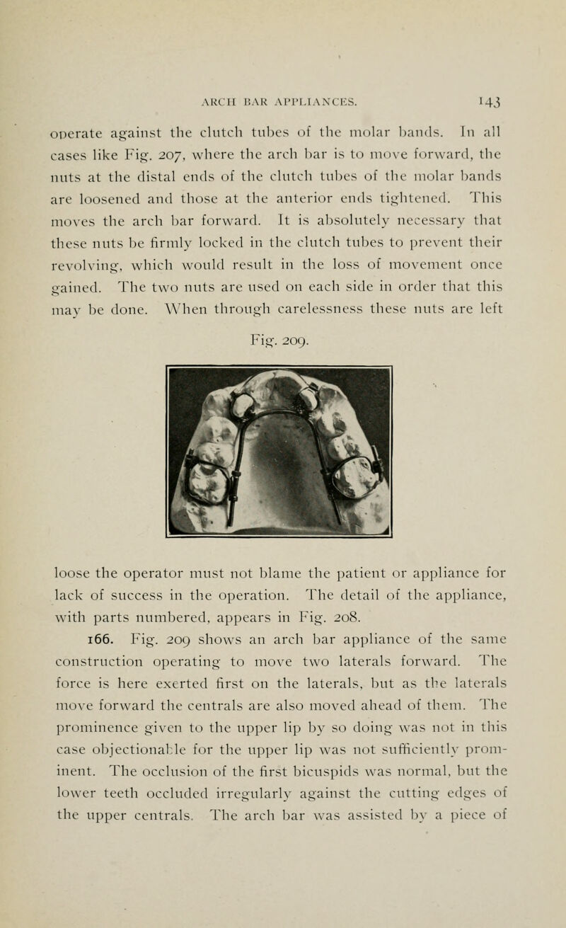 operate against the clutch tubes of the molar bands. In all cases like Fig. 207, where the arch bar is to move forward, the nuts at the distal ends of the clutch tubes of the molar bands are loosened and those at the anterior ends tightened. This moves the arch bar forward. It is absolutely necessary that these nuts be firmly locked in the clutch tubes to prevent their revolving, which would result in the loss of movement once gained. The two nuts are used on each side in order that this may be done. When through carelessness these nuts are left Fig. 200. loose the operator must not blame the patient or appliance for lack of success in the operation. The detail of the appliance, with parts numbered, appears in Fig. 208. 166. Fig. 209 shows an arch bar appliance of the same construction operating to move two laterals forward, ddie force is here exerted first on the laterals, but as the laterals move forward the centrals are also moved ahead of them. The prominence given to the upper lip by so doing was not in this case objectionable for the upper lip was not sufficiently prom- inent. The occlusion of the first bicuspids was normal, but the lower teeth occluded irregularly against the cutting edges of the upper centrals. The arch bar was assisted by a piece of