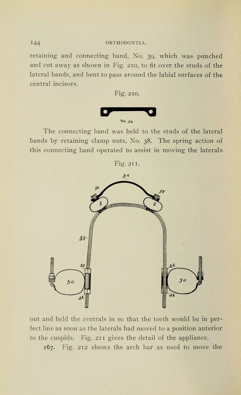 retaining and connecting band, Xo. 39, which was punched and cut away as shown in Fig. 210, to fit over the studs of the lateral bands, and bent to pass around the labial surfaces of the central incisors. Fie. 210. No 30 The connecting- band was held to the studs of the lateral bands by retaining clamp nuts, Xo. 38. The spring action of this connecting band operated to assist in moving the laterals out and held the centrals in so that the teeth would be in per- fect line as soon as the laterals had moved to a position anterior to the cuspids. Fig. 211 gives the detail of the appliance. 167. Fig. 212 shows the arch bar as used to move the