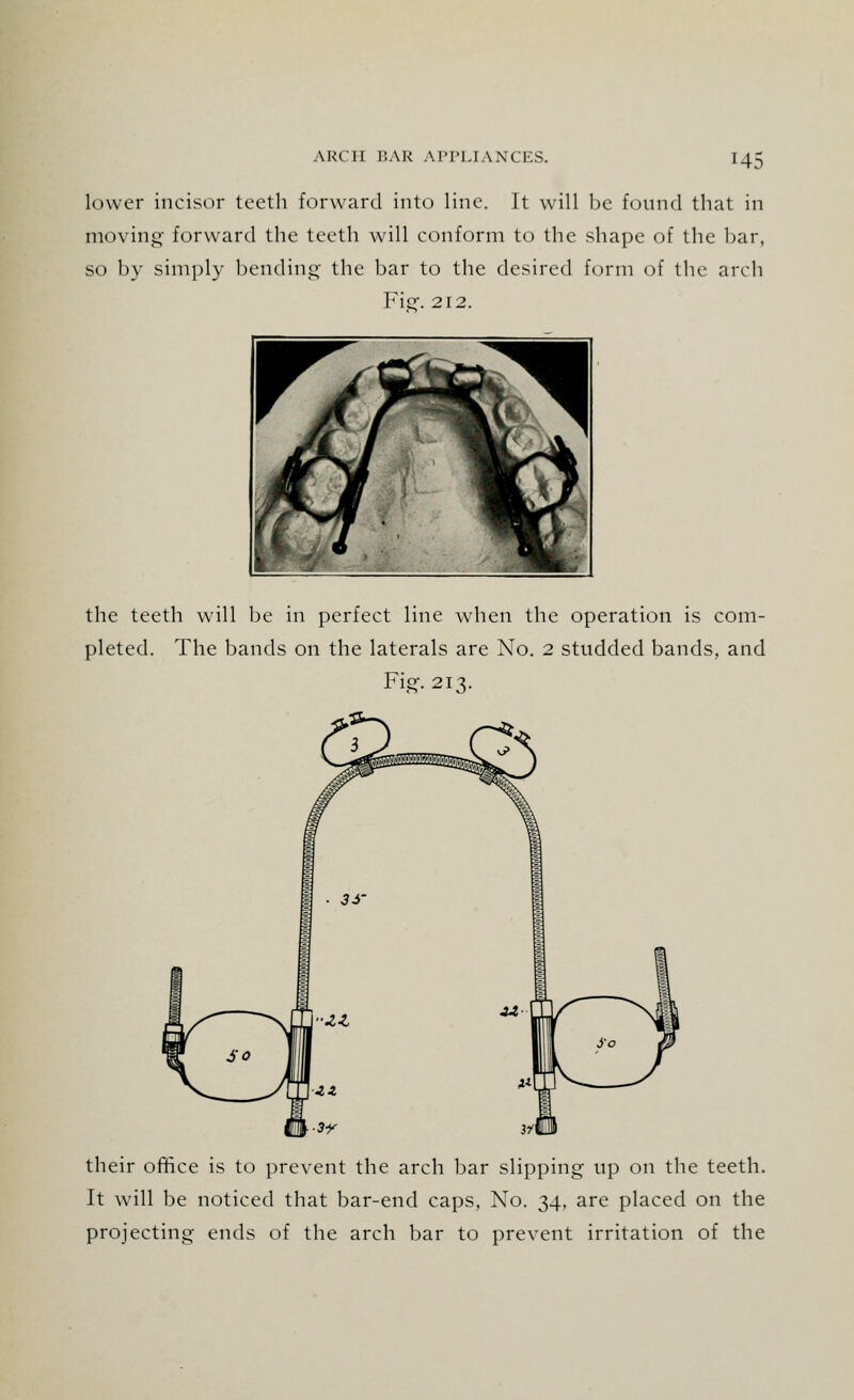 H5 lower incisor teeth forward into line. It will be found that in moving- forward the teeth will conform to the shape of the bar, so by simply bending the bar to the desired form of the arch Fig-. 212. the teeth will be in perfect line when the operation is com- pleted. The bands on the laterals are No. 2 studded bands, and Fig-. 213. ■J.Z their office is to prevent the arch bar slipping up on the teeth. It will be noticed that bar-end caps, No. 34, are placed on the projecting ends of the arch bar to prevent irritation of the