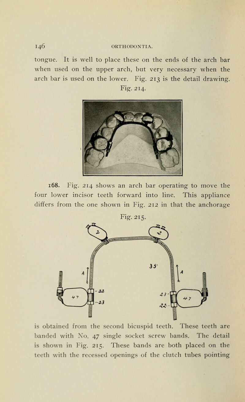 tongue. It is well to place these on the ends of the arch bar when used on the upper arch, but very necessary when the arch bar is used on the lower. Fig. 213 is the detail drawing. Fig. 214. 168. Fig. 214 shows an arch bar operating to move the four lower incisor teeth forward into line. This appliance differs from the one shown in Fig. 212 in that the anchorage Fig. 215. is obtained from the second bicuspid teeth. These teeth are banded with No. 47 single socket screw bands. The detail is shown in Fig. 215. These bands are both placed on the teeth with the recessed openings of the clutch tubes pointing