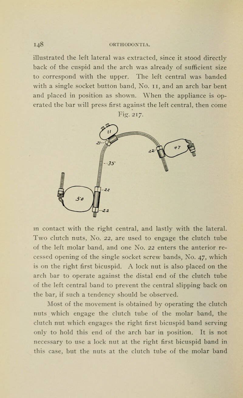 illustrated the left lateral was extracted, since it stood directly back of the cuspid and the arch was already of sufficient size to correspond with the upper. The left central was banded with a single socket button band. Xo. n, and an arch bar bent and placed in position as shown. When the appliance is op- erated the bar will press first against the left central, then come Fie. 217. in contact with the right central, and lastly with the lateral. Two clutch nuts, No. 22, are used to engage the clutch tube of the left molar band, and one Xo. 22 enters the anterior re- '1 opening of the single socket screw bands, Xo. 47, which is on the right first bicuspid. A lock nut is also placed on the arch bar to operate against the distal end of the clutch tube of the left central band to prevent the central slipping back on the bar, if such a tendency should be observed. Most of the movement is obtained by operating the clutch nuts which engage the clutch tube of the molar band, the clutch nut which engages the right first bicuspid band serving only to hold this end of the arch bar in position. It is not to use a lock nut at the right first bicuspid band in this case, but the nuts at the clutch tube of the molar band