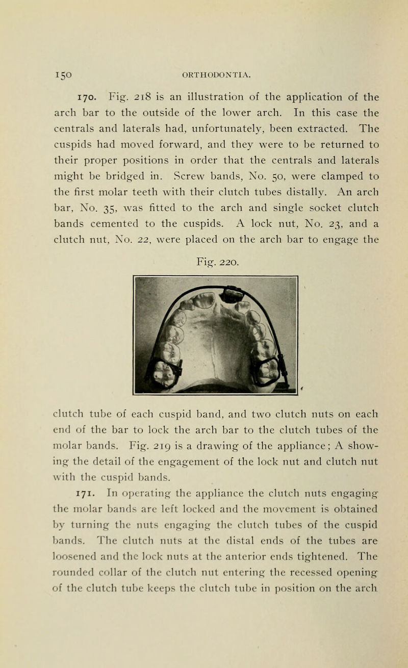 170. Fig. 218 is an illustration of the application of the arch bar to the outside of the lower arch. In this case the centrals and laterals had, unfortunately, been extracted. The cuspids had moved forward, and they were to be returned to their proper positions in order that the centrals and laterals might be bridged in. Screw bands, Xo. 50, were clamped to the first molar teeth with their clutch tubes distally. An arch bar. Xo. 35, was fitted to the arch and single socket clutch bands cemented to the cuspids. A lock nut. No. 23, and a clutch nut, Xo. 22, were placed on the arch bar to engage the Fie;- 220. clutch tube of each cuspid band, and two clutch nuts on each end of the bar to lock the arch bar to the clutch tubes of the molar bands. Fig. 219 is a drawing of the appliance; A show- ing the detail of the engagement of the lock nut and clutch nut with the cuspid bands. 171. In operating the appliance the clutch nuts engaging the molar band- arc left locked and the movement is obtained by turning the nut- engaging the clutch tubes of the cuspid Land-. The clutch nuts at the distal ends of the tubes are loosened and the lock nut- at the anterior ends tightened. The rounded collar of the clutch nut entering the recessed opening of tin- clutch tube keeps the clutch tube in position on the arch