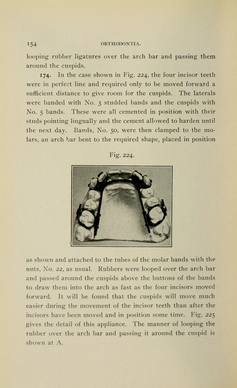 looping rubber ligatures over the arch bar and passing them around the cuspids. 174. In the case shown in Fig. 224, the four incisor teeth were in perfect line and required only to be moved forward a sufficient distance to give room for the cuspids. The laterals were banded with Xo. 3 studded bands and the cuspids with Xo. 5 bands. These were all cemented in position with their studs pointing lingually and the cement allowed to harden until the next day. Bands, Xo. 50, were then clamped to the mo- lars, an arch bar bent to the required shape, placed in position Fig. 224. ^ £7 1 *'*% ' as shown and attached to the tubes of the molar bands with the nuts, No. 22, as usual. Rubbers were looped over the arch bar and passed around the cuspids above the buttons of the bands to draw them into the arch as fast as the four incisors moved forward. It will be found that the cuspids will move much easier during the movement of the incisor teeth than after the incisors have been mined and in position some time. Fig. 225 gives the detail of this appliance. The manner of looping the rubber over the arch bar and passing it around the cuspid is shown at A.