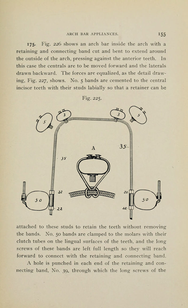 I75- Fig. 226 shows an arch har inside the arch with a retaining and connecting band cut and bent to extend around the outside of the arch, pressing against the anterior teeth. In this case the centrals are to be moved forward and the laterals drawn backward. The forces are equalized, as the detail draw- ing, Fig. 227, shows. No. 5 bands are cemented to the central incisor teeth with their studs labially so that a retainer can be Fig. 225. attached to these studs to retain the teeth without removing the bands. No. 50 bands are clamped to the molars with their clutch tubes on the lingual surfaces of the teeth, and the long screws of these bands are left full length so they will reach forward to connect with the retaining and connecting band. A hole is punched in each end of the retaining and con- necting band, No. 39, through which the long screws of the