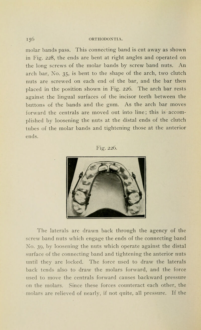 molar bands pass. This connecting band is cut away as shown in Fig. 228, the ends are bent at right angles and operated on the long screws of the molar bands by screw band nuts. An arch bar, Xo. 35, is bent to the shape of the arch, two clutch nuts are screwed on each end of the bar, and the bar then placed in the position shown in Fig. 226. The arch bar rests against the lingual surfaces of the incisor teeth between the buttons of the bands and the gum. As the arch bar moves forward the centrals are moved out into line; this is accom- plished by loosening the nuts at the distal ends of the clutch tubes of the molar bands and tightening those at the anterior ends. Fig. 226. The laterals arc drawn back through the agency of the screw band nuts which engage the ends of the connecting band No. 39, by loosening the nuts which operate against the distal surface of the connecting band and tightening the anterior nuts until they are locked. The force used to draw the laterals back tends also to draw the molars forward, and the force used to move the centrals forward causes backward pressure Oil the molars. Since these forces counteract each Other, the molars are relieved of nearly, if not quite, all pressure. If the