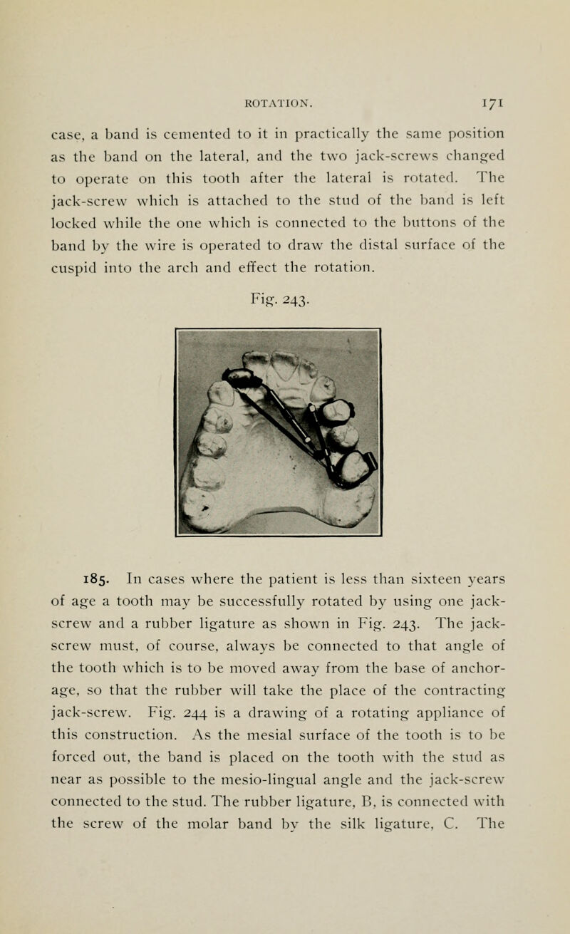 case, a band is cemented to it in practically the same position as the band on the lateral, and the two jack-screws changed to operate on this tooth after the lateral is rotated. The jack-screw which is attached to the stud of the band is left locked while the one which is connected to the buttons of the band by the wire is operated to draw the distal surface of the cuspid into the arch and effect the rotation. Fig. 243. 185. In cases where the patient is less than sixteen years of age a tooth may be successfully rotated by using one jack- screw and a rubber ligature as shown in Fig. 243. The jack- screw must, of course, always be connected to that angle of the tooth which is to be moved away from the base of anchor- age, so that the rubber will take the place of the contracting jack-screw. Fig. 244 is a drawing of a rotating appliance of this construction. As the mesial surface of the tooth is to be forced ont, the band is placed on the tooth with the stud as near as possible to the mesio-lingual angle and the jack-screw connected to the stud. The rubber ligature, B, is connected with the screw of the molar band bv the silk ligature. C. The
