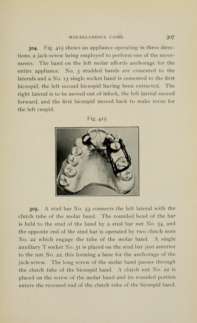 304. Fig. 415 shows an appliance operating in three direc- tions, a jack-screw being- employed to perform one of the move- ments. The band on the left molar affords anchorage for the entire appliance. No. 3 studded bands are cemented to the laterals and a No. 13 single socket band is cemented to the first bicuspid, the left second bicuspid having been extracted. The right lateral is to be moved out of inlock, the left lateral moved forward, and the first bicuspid moved back to make room for the left cuspid. Fig. 415. > fa* • ^ y\ T ^v ^\^ JL ^. JO pk 1^ f 'U&^\»\ ^ ', ^V^^ 305. A stud bar No. 53 connects the left lateral with the clutch tube of the molar band. The rounded head of the bar is held to the stud of the band by a stud bar nut No. 54. and the opposite end of the stud bar is operated by two clutch nuts No. 22 which engage the tube of the molar band. A single auxiliary T socket No. 31 is placed on the stud bar just anterior to the nut No. 22, this forming a base for the anchorage of the jack-screw. The long screw of the molar band passes through the clutch tube of the bicuspid band. A clutch nut No. 22 is placed on the screw of the molar band and its rounded portion enters the recessed end of the clutch tube of the bicuspid band.