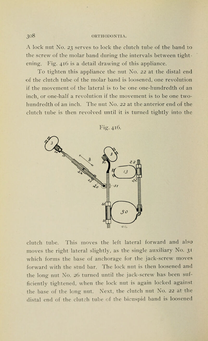A lock nut No. 23 serves to lock the clutch tube of the hand to the screw of the molar band during the intervals between tight- ening. Fig. 416 is a detail drawing of this appliance. To tighten this appliance the nut No. 22 at the distal end of the clutch tube of the molar band is loosened, one revolution if the movement of the lateral is to be one one-hundredth of an inch, or one-half a revolution if the movement is to be one two- hundredth of an inch. The nut Xo. 22 at the anterior end of the clutch tube is then revolved until it is turned tightly into the Fig-. 416. clutch tube. This moves the left lateral forward and also moves tbe right lateral slightly, as the single auxiliary No. 31 which forms the base of anchorage for the jack-screw moves forward with the Stud bar. The lock nut is then loosened and the long nut No. 26 turned until tin- jack-screw has been suf- ficiently tightened, when the lock nut is again locked against the b;i-<- of the long nut. Next, the clutch nut Xo. 22 .it tbe distal end of the clutch tube <-\ the bicuspid band is loosened
