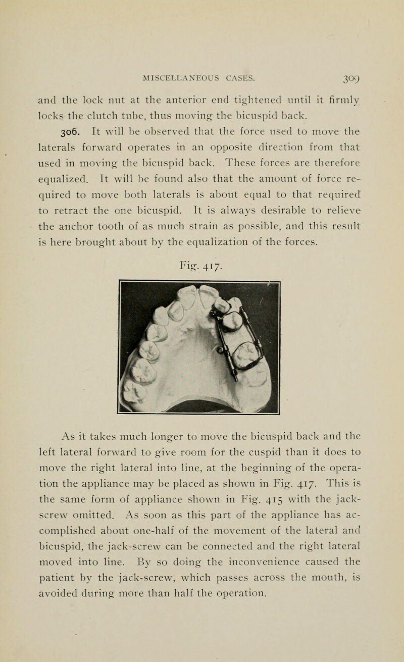 and the lock nut at the anterior end tightened until it firmly locks the clutch tube, thus moving the bicuspid back. 306. It will be observed that the force used to move the laterals forward operates in an opposite direction from that used in moving the bicuspid back. These forces arc therefore equalized. It will be found also that the amount of force re- quired to move both laterals is about equal to that required to retract the one bicuspid. It is always desirable to relieve the anchor tooth of as much strain as possible, and this result is here brought about by the equalization of the forces. Fig. 417. As it takes much longer to move the bicuspid back and the left lateral forward to give room for the cuspid than it does to move the right lateral into line, at the beginning of the opera- tion the appliance may be placed as shown in Fig. 417. This is the same form of appliance shown in Fig. 415 with the jack- screw omitted. As soon as this part of the appliance has ac- complished about one-half of the movement of the lateral and bicuspid, the jack-screw can be connected and the right lateral moved into line. By so doing the inconvenience caused the patient by the jack-screw, which passes across the mouth, is avoided during more than half the operation.