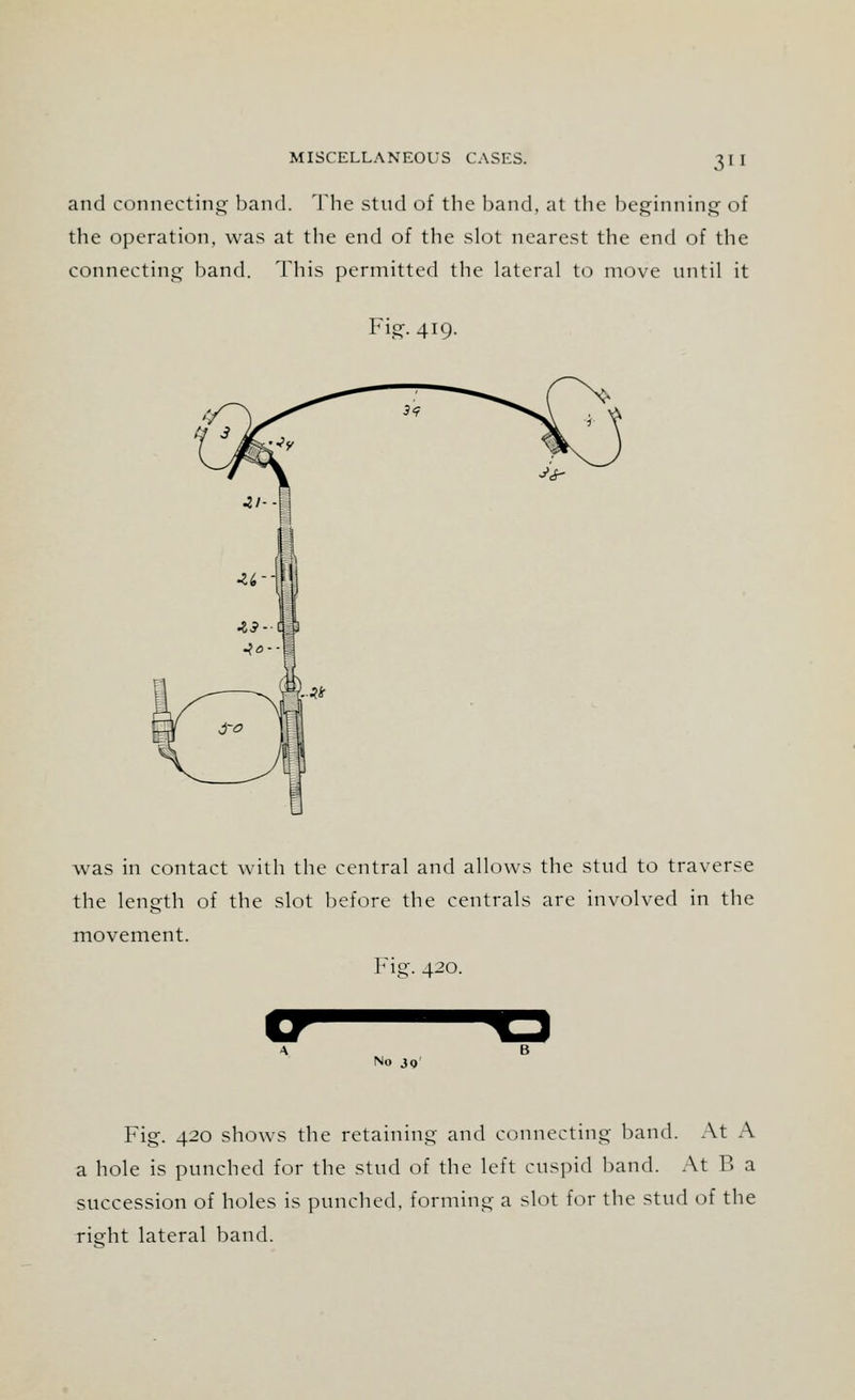 3 and connecting band. The stud of the band, at the beginning of the operation, was at the end of the slot nearest the end of the connecting band. This permitted the lateral to move until it Fij 419. was in contact with the central and allows the stud to traverse the length of the slot before the centrals are involved in the movement. Fig. 420. XT ^3 No 30 Fig. 420 shows the retaining and connecting band. At A a hole is punched for the stud of the left cuspid band. At B a succession of holes is punched, forming a slot for the stnd of the right lateral band.