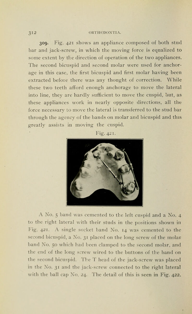 309. Fig. 421 shows an appliance composed of both stud bar and jack-screw, in which the moving force is equalized to some extent by the direction of operation of the two appliances. The second bicuspid and second molar were used for anchor- age in this case, the first bicuspid and first molar having been extracted before there was any thought of correction. While these two teeth afford enough anchorage to move the lateral into line, thev arc hardly sufficient to move the cuspid, but, as these appliances work in nearly opposite directions, all the force necessarv to move the lateral is transferred to the stud bar through the agency of the bands on molar and bicuspid and this greatly assists in moving the cuspid. Fig. 421. A No. 5 band was cemented to the left cuspid and a No. 4 to the right lateral with their studs in the positions shown in Fig. 421. A single sockel band No. 14 was cemented to the s< ond bicuspid, a No. 31 placed on the long screw of the molar band No. 50 which had been clamped to the second molar, and the end of the long screw wired to the buttons of the band on the second bicuspid. The T head of the jack-screw was placed in the No. 31 and the jack-screw connected to the right lateral with the ball cap No. 24. I he detail of this is seen in Fig. 422.