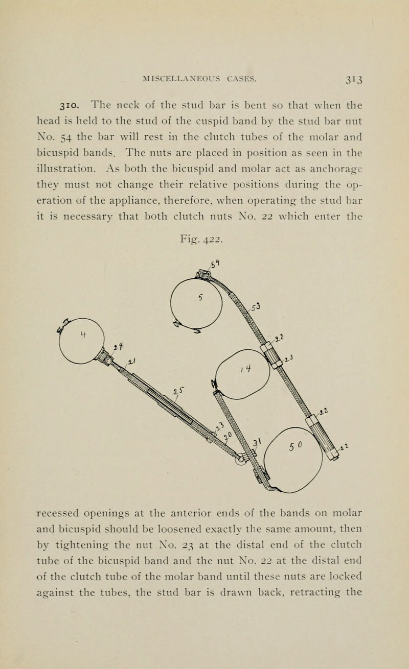 310. The neck of the stud bar is bent so that when the head is held to the stud of the cuspid band by the stud bar nut No. 54 the bar will rest in the clutch tubes of the molar and bicuspid bands. The nuts are placed in position as seen in the illustration. As both the bicuspid and molar act as anehorage they must not change their relative positions during the op- eration of the appliance, therefore, when operating the stud bar it is necessary that both clutch nuts No. 22 which enter the recessed openings at the anterior ends of the bands on molar and bicuspid should be loosened exactly the same amount, then by tightening the nut Xo. 23 at the distal end of the clutch tube of the bicuspid band and the nut Xo. 22 at the distal end oi the clutch tube of the molar band until these nuts are locked against the tubes, the stud bar is drawn back, retracting the