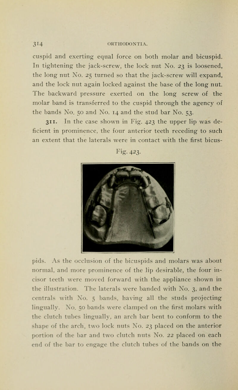 cuspid and exerting equal force on both molar and bicuspid. In tightening the jack-screw, the lock nut No. 2$ is loosened, the long nut Xo. 25 turned so that the jack-screw will expand, and the lock nut again locked against the base of the long nut. The backward pressure exerted on the long screw of the molar band is transferred to the cuspid through the agency of the bands Xo. 50 and Xo. 14 and the stud bar No. 53. 311. In the case shown in big. 423 the upper lip was de- ficient in prominence, the four anterior teeth receding to such an extent that the laterals were in contact with the first bicus- Fig. 423. pids. As the occlusion of the bicuspids and molars was about normal, and more prominence of the lip desirable, the four in- cisor teeth were- moved forward with the appliance shown in the illustration. The laterals were banded with No. 3, and the centrals with No, 5 bands, having all tin- studs projecting lingually. Xo. 50 bands were clamped on the first molars with the clutch tubes lingually, an arch bar bent to conform to the shape of the arch, two lock nuts No. 23 placed on the anterior portion of the bar and two clutch nnts Xo. 22 placed on each end of the bar to engage the clutch tubes of the bands on the
