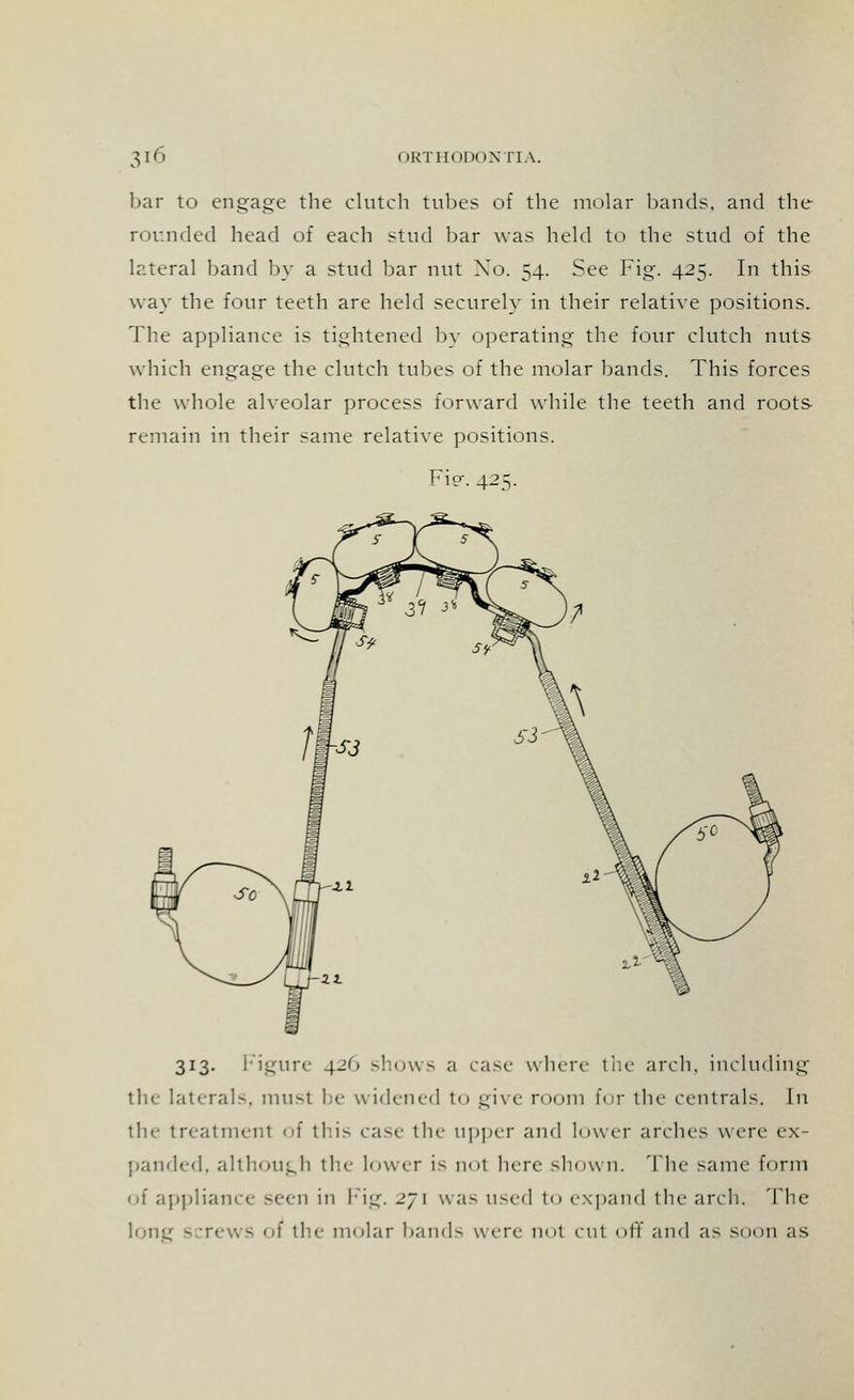 bar to engage the clutch tubes of the molar bands, and the rounded head of each stud bar was held to the stud of the lateral band by a stud bar nut Xo. 54. See Fig. 425. In this way the four teeth are held securely in their relative positions. The appliance is tightened by operating the four clutch nuts which engage the clutch tubes of the molar bands. This forces the whole alveolar process forward while the teeth and roots remain in their same relative positions. Fie. 425. 313. Figure 426 shows a case where the arch, including the laterals, must be widened to give room for the centrals. In the treatment of this case the upper and lower arches were ex- panded, although the lower i^ not here shown. The same form of appliance seen in Fig. 271 was used to expand the arch. The long screws 01 the molar bands wn-c not cut off and a^ soon as
