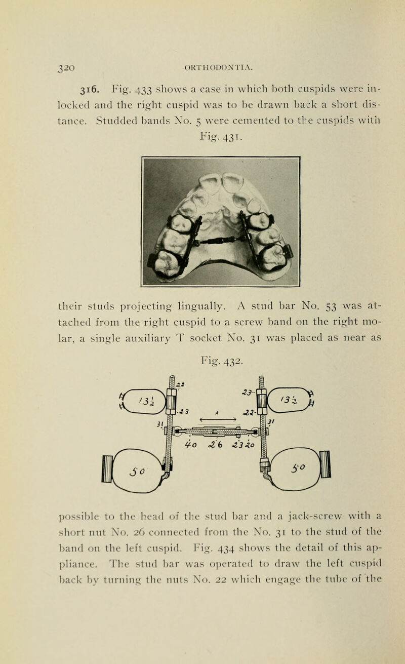 316. Fig. 433 shows a case in which both cuspids were in- locked and the right cuspid was to be drawn back a short dis- tance. Studded bands No. 5 were cemented to the cuspids with Fig. 43 !■ ~M > I w<*. (Hfe mrZl ML ^\ Jmmm^ *■ \^ |fj..^ their studs projecting lingually. A stud bar No. 53 was at- tached from the right cuspid to a screw band on the right mo- lar, a single auxiliary T socket No. 31 was placed as near as Fig- 432- possible to the head of the Stud liar ;'.nd a jack-screw with a shorl nnt No. 26 connected from the No. 31 to the stud of the hand on the left cuspid. Fig. 434 shows the detail of this ap- pliance. The stud bar was operated to draw the lefl cuspid hark bv turning the nuts No. 22 which engage the tube of the