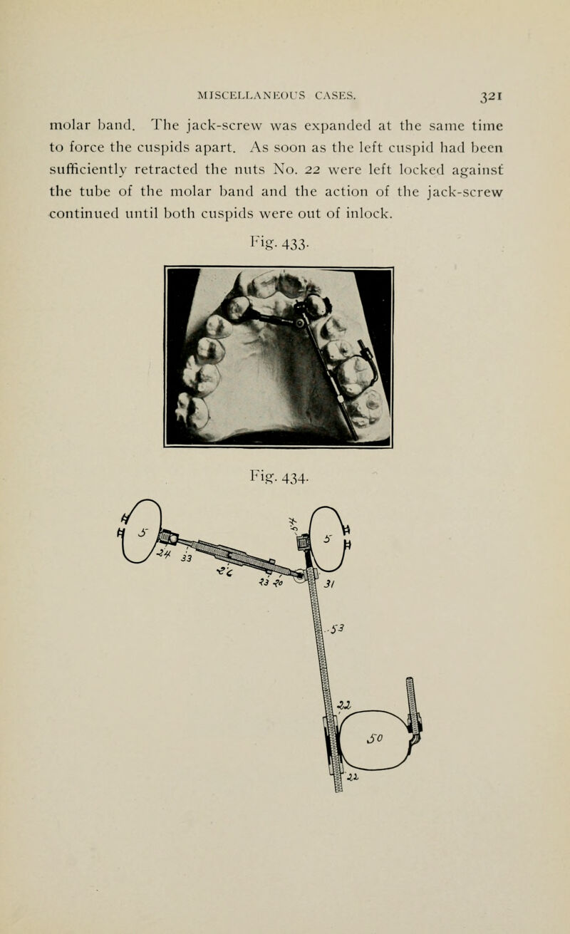 molar hand. The jack-screw was expanded at the same time to force the cuspids apart. As soon as the left cuspid had heen sufficiently retracted the nuts No. 22 were left locked against the tube of the molar band and the action of the jack-screw continued until both cuspids were out of inlock. Fig. 433-
