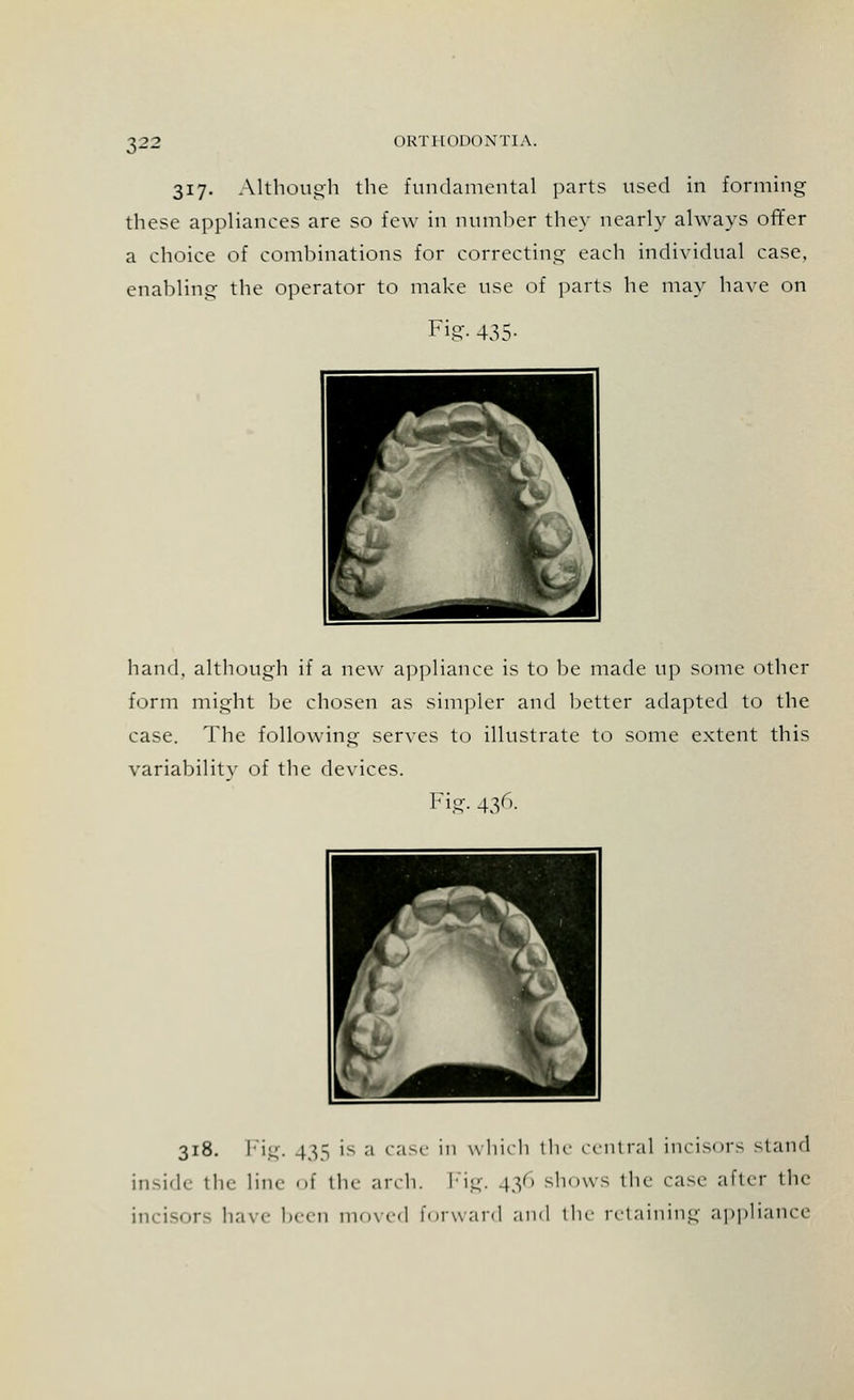 317. Although the fundamental parts used in forming these appliances are so few in number they nearly always offer a choice of combinations for correcting each individual case, enabling the operator to make use of parts he may have on Fig. 435- hand, although if a new appliance is to be made up some other form might be chosen as simpler and better adapted to the case. The following serves to illustrate to some extent this variability of the devices. Fig. 436. 318. Fig. 43s is a case in which the central incisors stand inside the line of the arch. Fig. 436 shows the case after the incisors have been moved forward and the retaining appliance