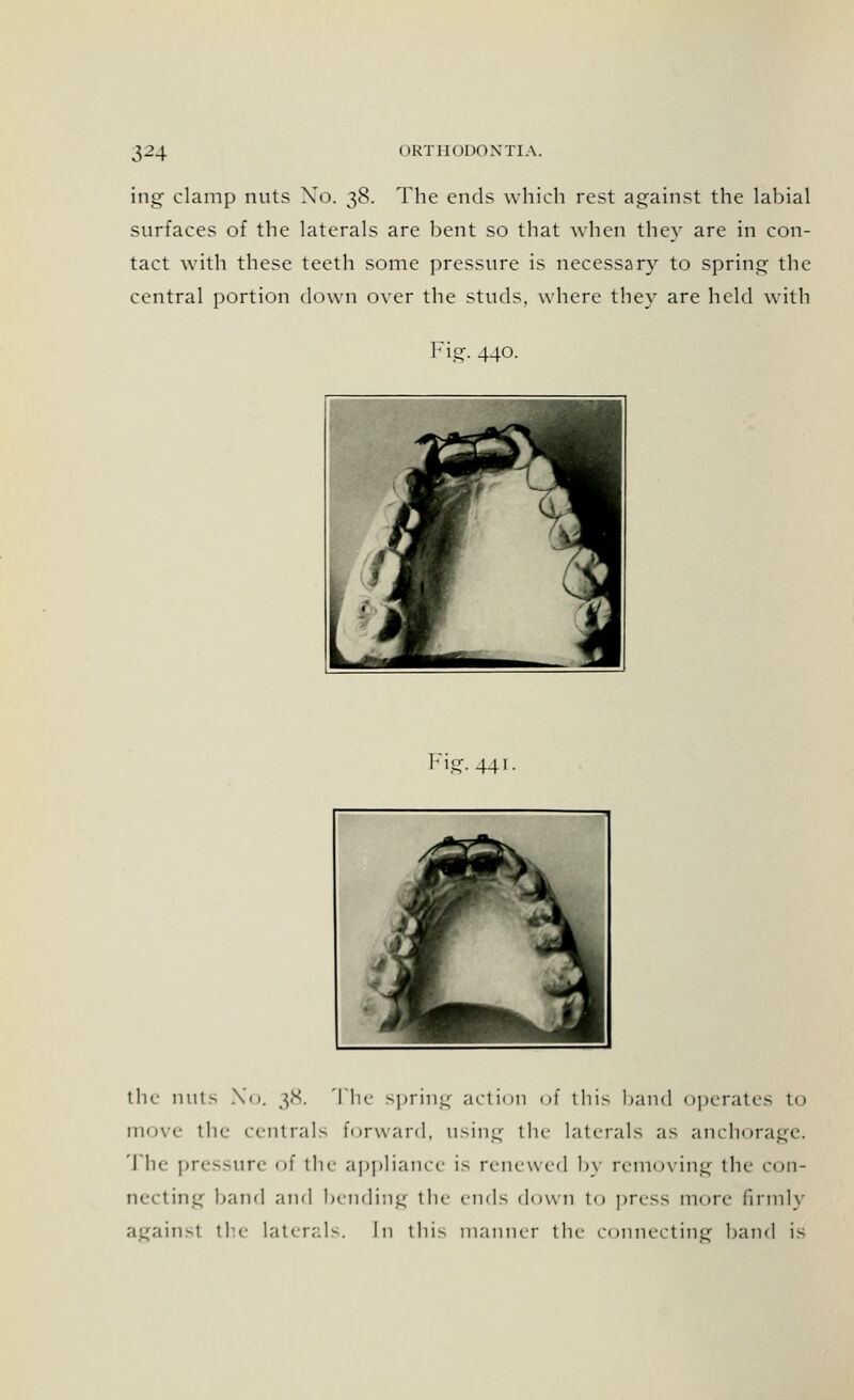 ing clamp nuts Xo. 38. The ends which rest against the labial surfaces of the laterals are bent so that when they are in con- tact with these teeth some pressure is necessary to spring the central portion down over the studs, where they are held with Fig. 440. ig-44i the nuts Xo. 38. The spring action of this band operates to move the centrals forward, using the laterals as anchorage. The pressure of the appliance is renewed by removing the con- necting band and bending the ends down to press more firmly againsl the lateral-. In this manner the connecting band is