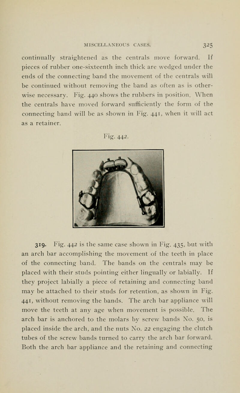 continually straightened as the centrals move forward. It pieces of rubber one-sixteenth inch thick are wedged under the ends of the connecting band the movement of the centrals will be continued without removing the band as often as is other- wise necessary. Fig. 440 shows the rubbers in position. When the centrals have moved forward sufficiently the form of the connecting band will be as shown in Fig. 441. when it will act as a retainer. Fig. 44-7- 319. Fig. 442 is the same case shown in Fig. 435, but with an arch bar accomplishing the movement of the teeth in place of the connecting- band. The bands on the centrals may be placed with their studs pointing either lingually or labially. If they project labially a piece of retaining and connecting band may be attached to their studs for retention, as shown in Fig. 441, without removing the bands. The arch bar appliance will move the teeth at any age when movement is possible. The arch bar is anchored to the molars by screw bands Xo. 50. is placed inside the arch, and the nuts Xo. 22 engaging the clutch tubes of the screw bands turned to carry the arch bar forward. Both the arch bar appliance and the retaining and connecting