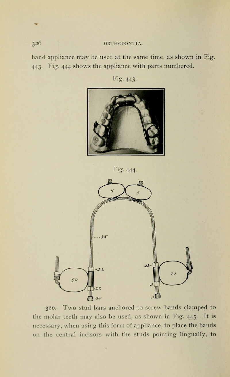 band appliance may be used at the same time, as shown in Fig. 443. Fig. 444 shows the appliance with parts numbered. Fig- 443- Fig. 444. 13. 320. Two stud bars anchored to screw bands clamped to the molar teeth may also be used, as shown in Fig. 445. It is necessary, when using this form of appliance, to place the bands 0:1 the central incisors with the studs pointing lingually, to