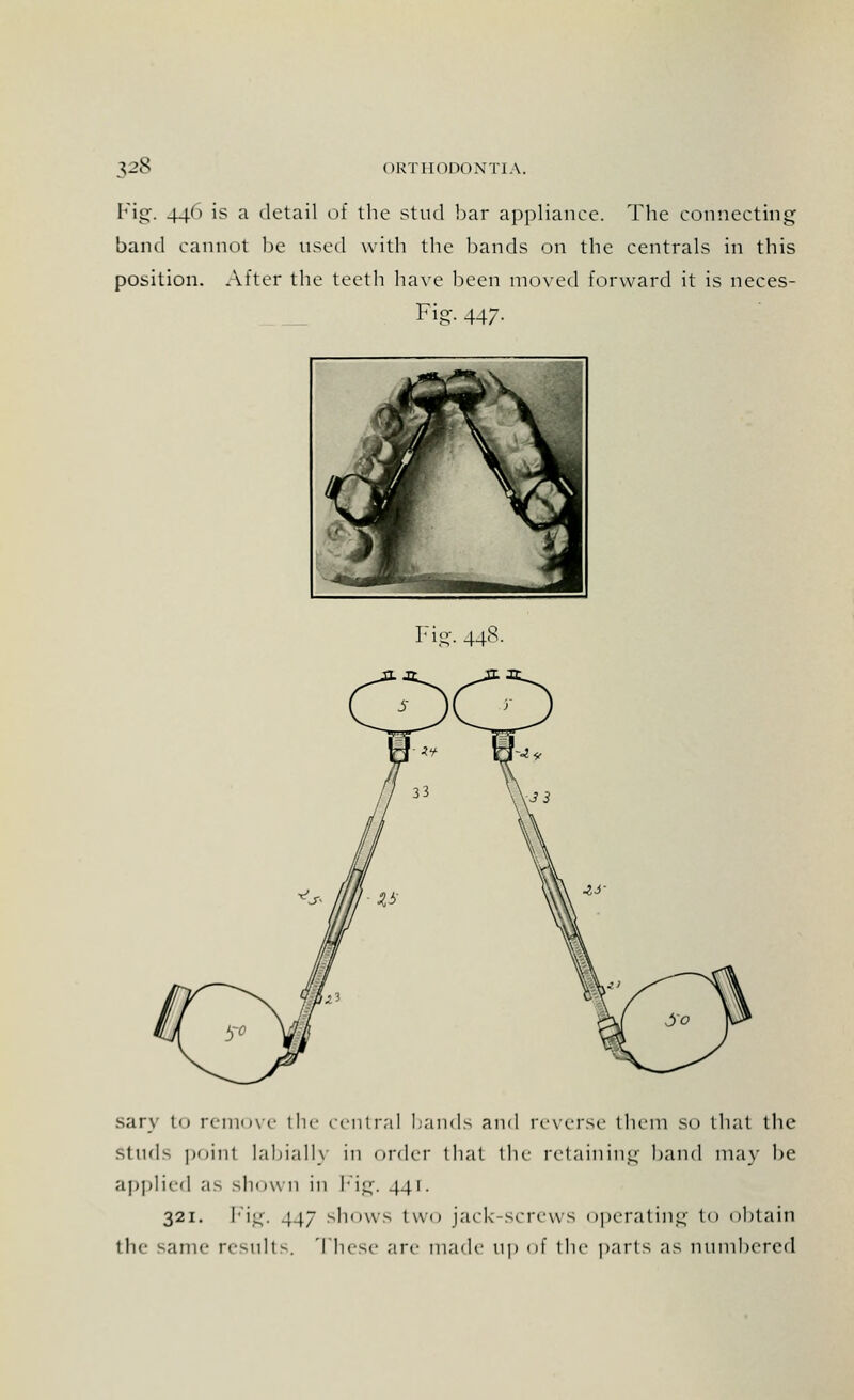 Fig. 440 is a detail of the stud bar appliance. The connecting band cannot be used with the bands on the centrals in this position. After the teeth have been moved forward it is neces- Fig. 4-17- rJl+»x\ . Jwt J/S «v m ^ . Fig. 448. sary to remove the central Lands and reverse them so that the studs point labially in order that the retaining hand may he applied as shown in Fig. 441. 321. Fig. 447 shows two jack-screws operating to obtain the same results. These are made Up of the parts as numbered