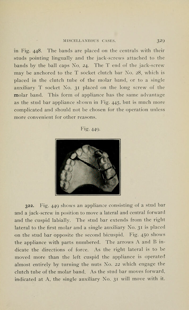 in Fig. 448. The bands are placed on the centrals with their studs pointing lingually and the jack-screws attached to the bands by the ball caps No. 24. The T end of the jack-screw may be anchored to the T socket clutch bar No. 28, which is placed in the clutch tube of the molar band, or to a single auxiliary T socket Xo. 31 placed on the long screw of the molar band. This form of appliance has the same advantage as the stud bar appliance shown in Fig. 445, but is much more complicated and s'hould not be chosen for the operation unless more convenient for other reasons. Fig. 44Q. 322. Fig. 449 shows an appliance consisting- of a stud bar and a jack-screw in position to move a lateral and central forward and the cuspid labially. The stud bar extends from the right lateral to the first molar and a single auxiliary No. 31 is placed on the stud bar opposite the second bicuspid. Fig. 450 shows the appliance with parts numbered. The arrows A and V. in- dicate the directions of force. As the right lateral is to be moved more than the left cuspid the appliance is operated almost entirely by turning the nuts No. 22 which engage the clutch tube of the molar band. As the stud bar moves forward, indicated at A, the single anxiliary No. 31 will move with it.