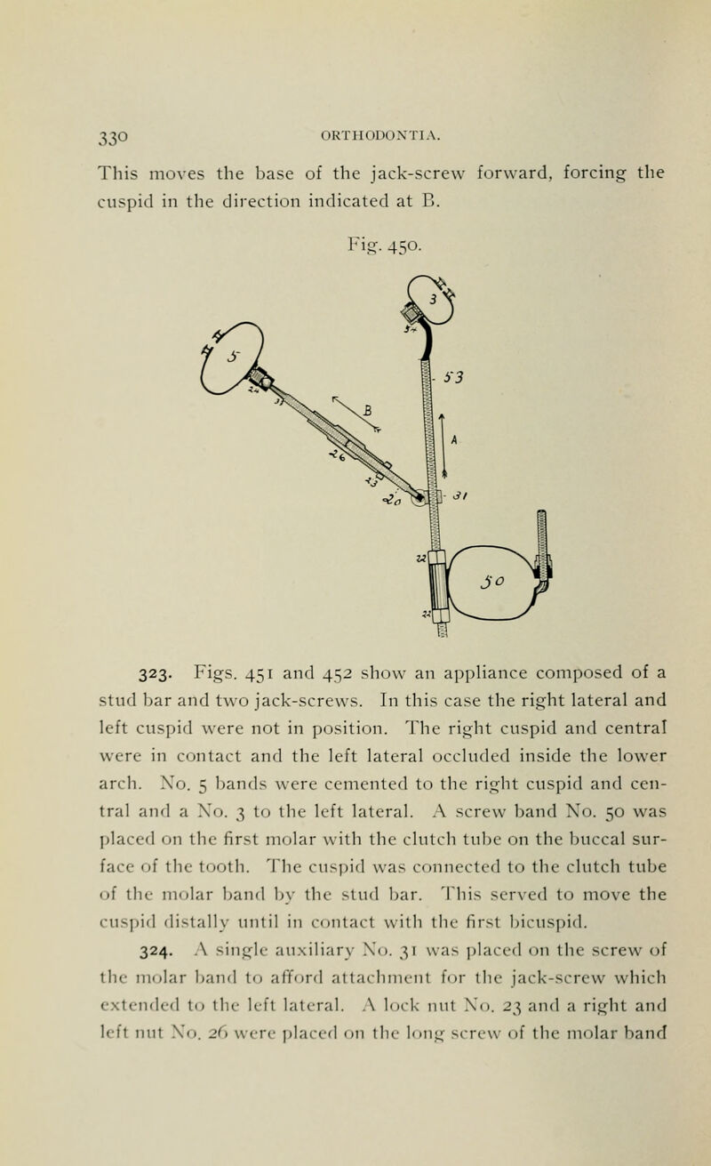 33° ( IKTIIODOX'I IA. This moves the base of the jack-screw forward, forcing the cuspid in the direction indicated at B. Fig- 45°- 323. Figs. 451 and 452 show an appliance composed of a stud bar and two jack-screws. In this case the right lateral and left cuspid were not in position. The right cuspid and central were in contact and the left lateral occluded inside the lower arch. Xo. 5 bands were cemented to the right cuspid and cen- tral and a Xo. 3 to the left lateral. A screw band No. 50 was placed on the first molar with the clutch tube on the buccal sur- face of the tooth. The cuspid was connected to the clutch tube of the molar band by the stud bar. This served to move the CUSpid distally until in contact with the first bicuspid. 324. A single auxiliary No. 31 was placed 011 the screw of the molar band to afford attachment for the jack-screw which extended to the left lateral. A lock nul Xo. 23 and a right and lefl nu1 Xo. Jo were placed on the long screw of the molar band