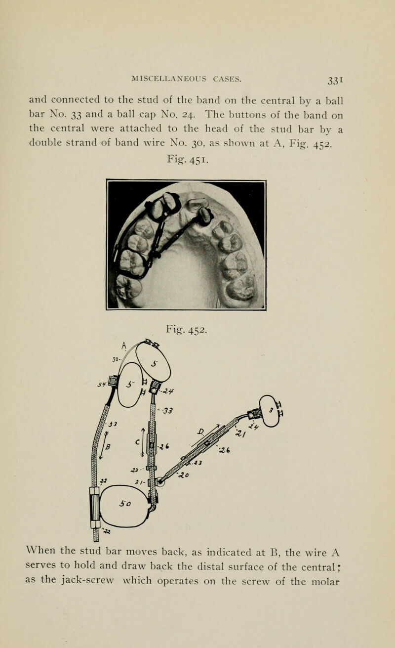 and connected to the stud of the band on the central by a ball bar No. 33 and a ball cap No. 24. The buttons of the band on the central were attached to the head of the stud bar by a double strand of band wire No. 30, as shown at A, Fig. 4^2. Fig:-451. Fig- 452- When the stud bar moves back, as indicated at B. the wire A serves to hold and draw back the distal surface of the central; as the jack-screw which operates on the screw of the molar