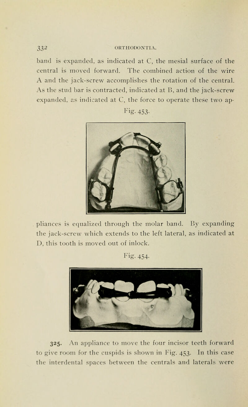 band is expanded, as indicated at C, the mesial surface of the central is moved forward. The combined action of the wire A and the jack-screw accomplishes the rotation of the central. As the stud bar is contracted, indicated at B, and the jack-screw expanded, as indicated at C, the force to operate these two ap- Fig- 453- pliances is equalized through the molar band. By expanding the jack-screw which extends to the left lateral, as indicated at I), this tooth is moved out of inlock. Fig- 454- 325. An appliance to move the lour incisor teeth Forward to give room for the cuspids is shown in Fig. 453. In this case the interdental spaces between the centrals and laterals were