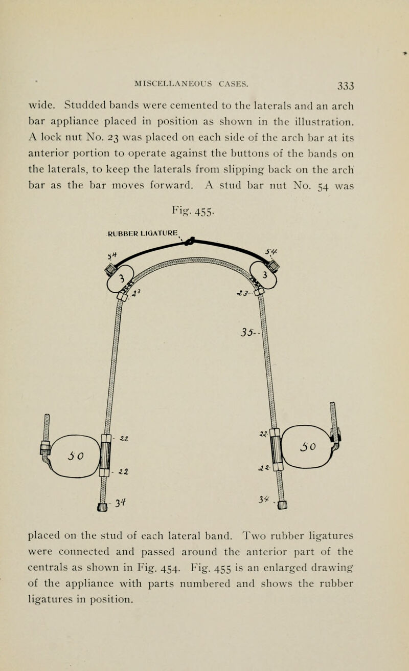 wide. Studded hands were cemented to the laterals and an arch bar appliance placed in position as shown in the illustration. A lock nut No. 2$ was placed on each side of the arch bar at its anterior portion to operate against the buttons of the hands on the laterals, to keep the laterals from slipping hack on the arch bar as the bar moves forward. A stud bar nut No. 54 was placed on the stud of each lateral band. Two rubber ligatures were connected and passed around the anterior part of the centrals as shown in Fig. 454. Fig. 455 is an enlarged drawing of the appliance with parts numbered and shows the rubber ligatures in position.