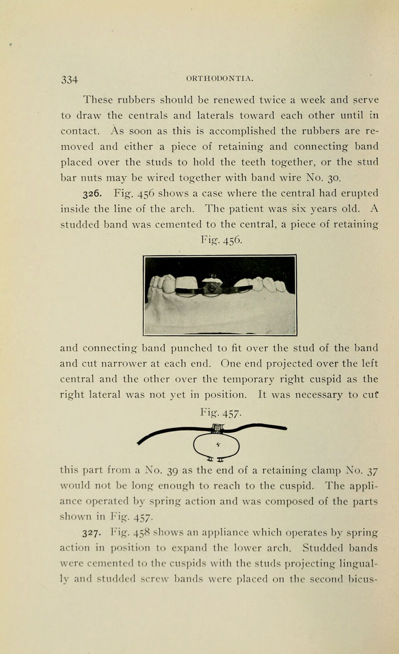 These rubbers should be renewed twice a week and serve to draw the centrals and laterals toward each other until in contact. As soon as this is accomplished the rubbers are re- moved and either a piece of retaining and connecting' band placed over the studs to hold the teeth together, or the stud bar nuts may be wired together with band wire No. 30. 326. Fig. 456 shows a case where the central had erupted inside the line of the arch. The patient was six years old. A studded band was cemented to the central, a piece of retaining Fig. 456. and connecting band punched to fit over the stud of the band and cut narrower at each end. One end projected over the left central and the other over the temporary right cuspid as the right lateral was not yet in position. It was necessary to cut* Fig- 457- this pari from a No. 39 as the end of a retaining clamp No. 37 would not 1m- Long enough to reach to the cuspid. The appli- ance operated by spring action and was composed of the parts sh< mil in Fig. 457. 327. Fig. 458 •-hows an appliance which operates by spring action in position to expand the lower arch. Studded bands were cemented to the cuspids with the studs projecting lingual- ]v and studded screw hands were placed on the second bicus