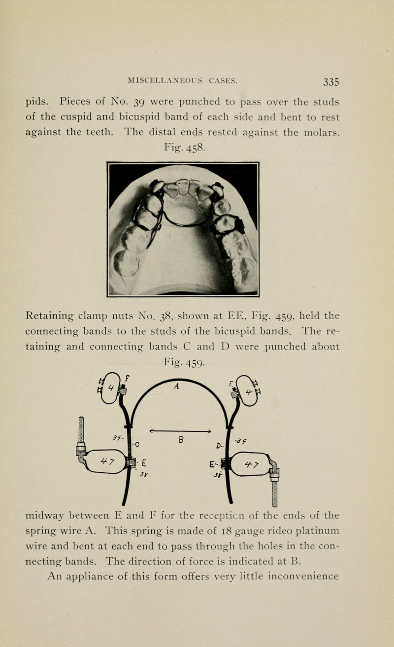pids. Pieces of No. 39 were punched to pass over the studs of the cuspid and bicuspid band of each side and bent to rest against the teeth. The distal ends rested against the molars. Fig. 458. Retaining clamp nuts No. 38, shown at EE, Fig. 459, held the connecting bands to the studs of the bicuspid bands. The re- taining and connecting bands C and D were punched about Fig- 459- midway between E and F for the recepticn of the ends of the spring wire A. This spring is made of 18 gauge rideo platinum wire and bent at each end to pass through the holes in the con- necting bands. The direction of force is indicated at B. An appliance of this form offers very little inconvenience