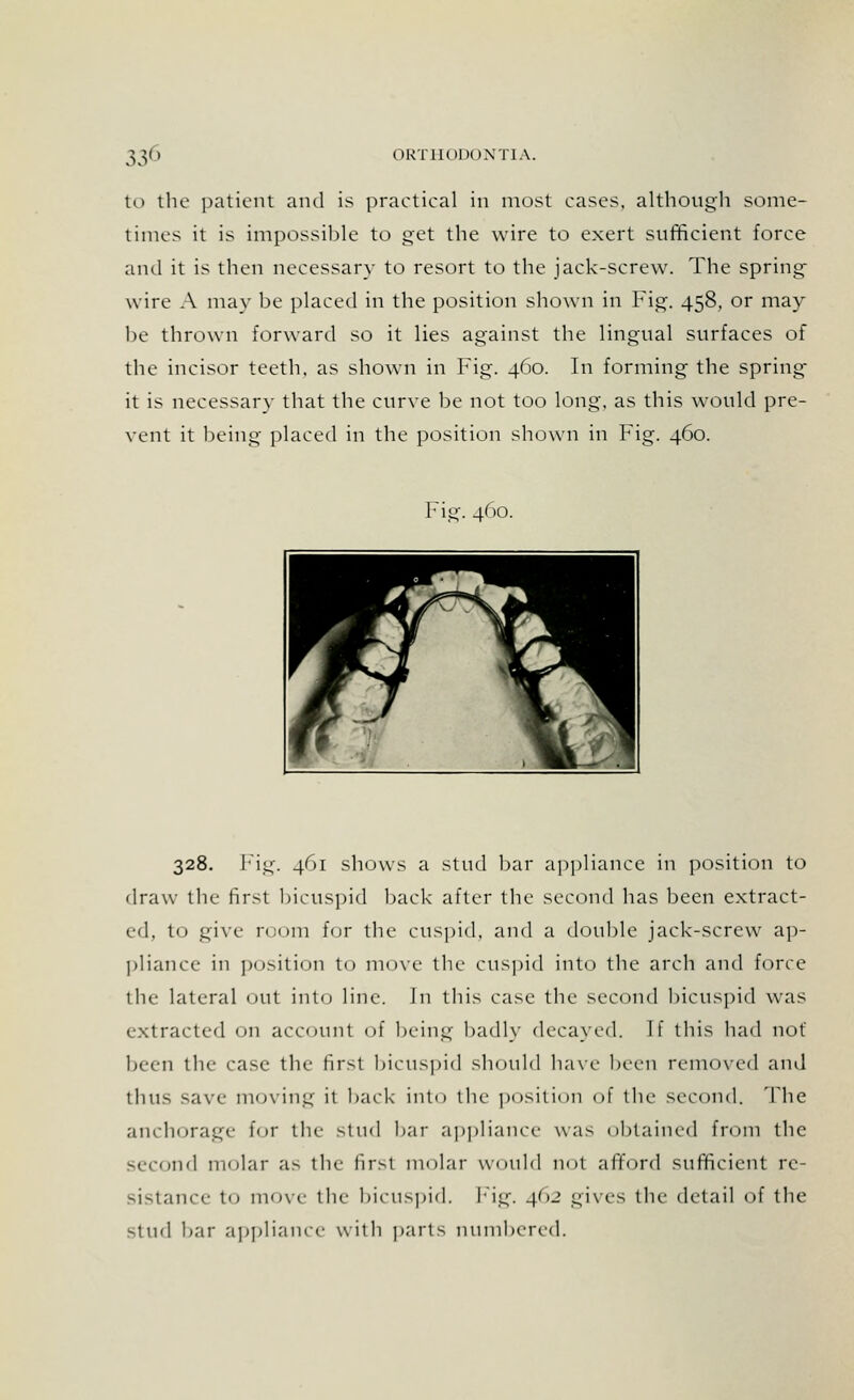 to the patient and is practical in most cases, although some- times it is impossible to get the wire to exert sufficient force and it is then necessary to resort to the jack-screw. The spring wire A may be placed in the position shown in Fig. 458, or may be thrown forward so it lies against the lingual surfaces of the incisor teeth, as shown in Fig. 460. In forming the spring- it is necessary that the curve be not too long, as this would pre- vent it being placed in the position shown in Fig. 460. Fig. 400. 328. Fig. 461 shows a stud bar appliance in position to draw the first bicuspid back after the second has been extract- ed, to give room for the cuspid, and a double jack-screw ap- pliance in position to move the cuspid into the arch and force the lateral out into line. In this case the second bicuspid was extracted on account of being badly decayed. If this had not been the case the first bicuspid should have been removed and thus save mining it back into the position ol the second. The anchorage for the stud bar appliance was obtained from the second molar as the first molar would not .afford sufficient re- sistance to move the bicuspid. Fig. 402 gives the detail of the stud bar appliance with parts numbered.