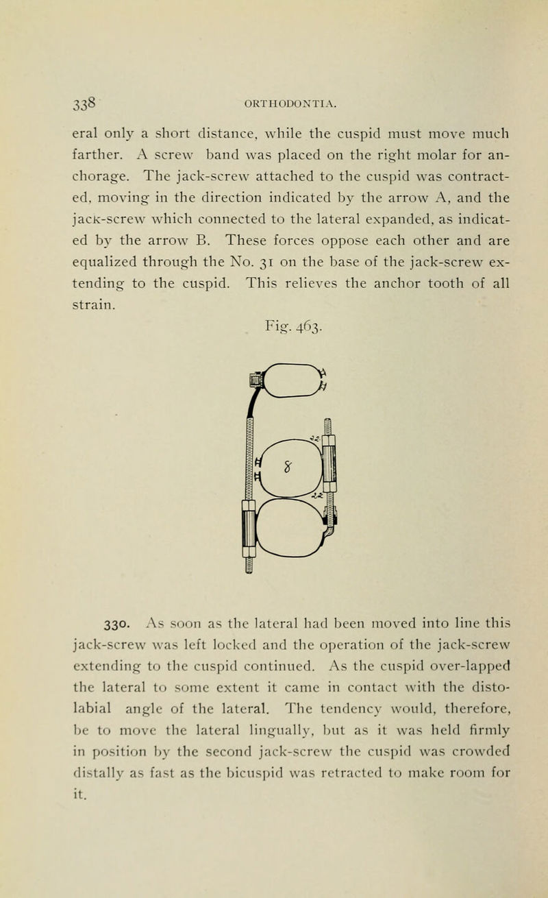 eral only a short distance, while the cuspid must move much farther. A screw band was placed on the right molar for an- chorage. The jack-screw attached to the cuspid was contract- ed, moving in the direction indicated by the arrow A, and the jack-screw which connected to the lateral expanded, as indicat- ed by the arrow B. These forces oppose each other and are equalized through the No. 31 on the base of the jack-screw ex- tending to the cuspid. This relieves the anchor tooth of all strain. Fig. 463. 330. As soon as the lateral had been moved into line this jack-screw was left locked and the operation of the jack-screw extending to the cuspid continued. As the cuspid over-lapped the lateral to some extent it came in contact with the disto- labial angle of the lateral. The tendency would, therefore, be to move the lateral linguallv, but as it was held firmly in position by the second jack-screw the cuspid was crowded distally as Easl as the bicuspid was retracted i make room for it.