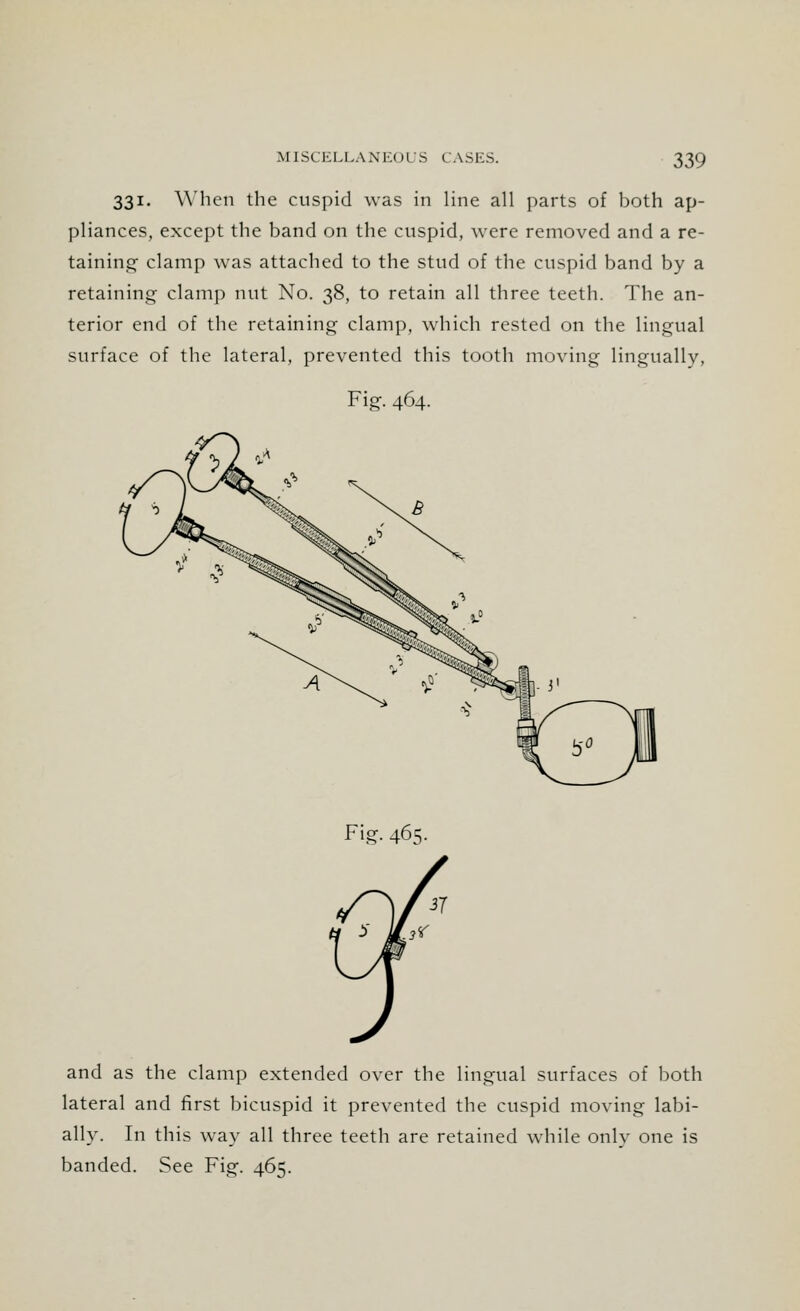 331. When the cuspid was in line all parts of both ap- pliances, except the band on the cuspid, were removed and a re- taining clamp was attached to the stud of the cuspid band by a retaining clamp nut No. 38, to retain all three teeth. The an- terior end of the retaining clamp, which rested on the lingual surface of the lateral, prevented this tooth moving lingually, Fig. 464. Fig. 465. and as the clamp extended over the lingual surfaces of both lateral and first bicuspid it prevented the cuspid moving labi- ally. In this way all three teeth are retained while only one is banded. See Fig. 465.