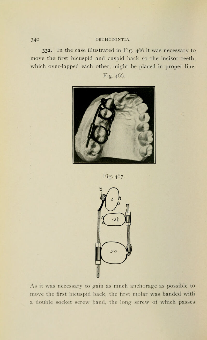 332. In the case illustrated in Fig. 466 it was necessary to move the first bicuspid and cuspid back so the incisor teeth, which over-lapped each other, might be placed in proper line. Fig. 466. Fig. 467. As it was necessary t<> gain as much anchorage as possible to move the first bicuspid back, the firsl molar was banded with a double socket screw hand, the long screw of which passes