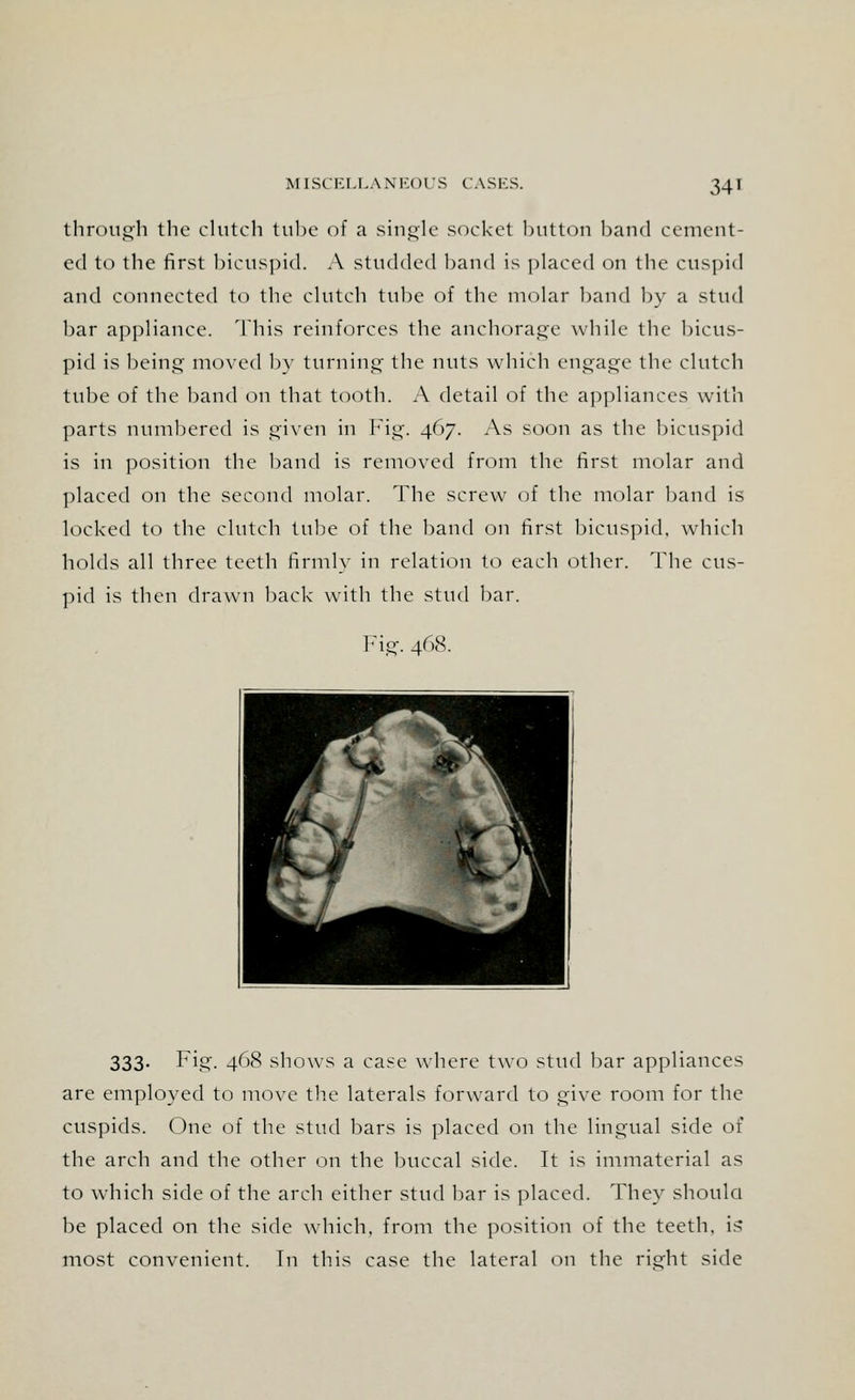 through the clutch tube of a single socket button band cement- ed to the first bicuspid. A studded band is placed on the cuspid and connected to the clutch tube of the molar band by a stud bar appliance. This reinforces the anchorage while the bicus- pid is being moved by turning the nuts which engage the clutch tube of the band on that tooth. A detail of the appliances with parts numbered is given in Fig. 467. As soon as the bicuspid is in position the band is removed from the first molar and placed on the second molar. The screw of the molar band is locked to the clutch tube of the band on first bicuspid, which holds all three teeth firmly in relation to each other. The cus- pid is then drawn back with the stud bar. Fig. 468. 333- Fig. 468 shows a case where two stud bar appliances are employed to move the laterals forward to give room for the cuspids. One of the stud bars is placed on the lingual side of the arch and the other on the buccal side. It is immaterial as to which side of the arch either stud bar is placed. They should be placed on the side which, from the position of the teeth, is most convenient. In this case the lateral on the right side