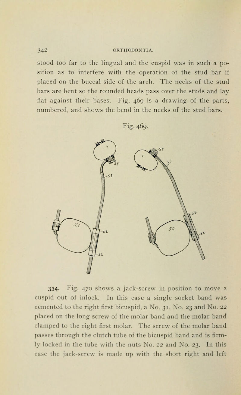 stood too far to the lingual and the cuspid was in such a po- sition as to interfere with the operation of the stud bar if placed on the buccal side of the arch. The necks of the stud bars are bent so the rounded heads pass over the studs and lay flat against their bases. Fig. 469 is a drawing of the parts, numbered, and shows the bend in the necks of the stud bars. Fig. 469. 334. Fig. 470 shows a jack-screw in position to move a cuspid out of inlock. In this case a single socket band was cemented to the right first bicuspid, a No. 31, Xo. 23 and No. 22 placed on the long screw of the molar band and the molar band clamped to the right first molar. The screw of the molar band passes through the clutch tube of the bicuspid band and is firm- ly locked in the tube- with the nuts Xo. 22 and No. 2$. In this case the jack-screw is made up with tlu- shorl right and left